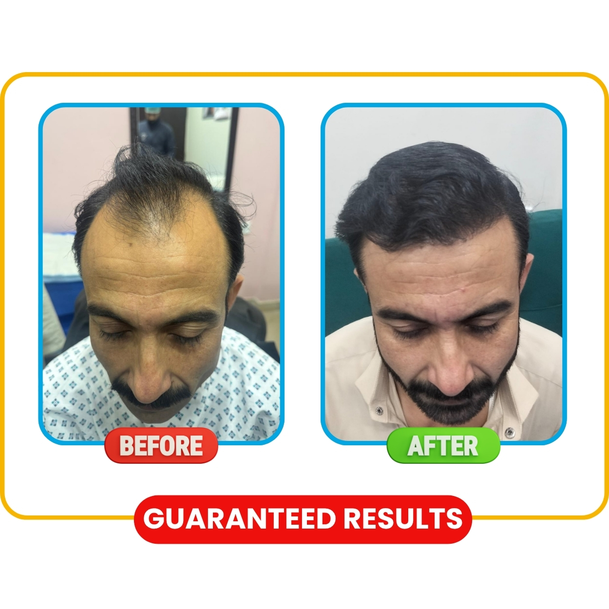 Hair Transplant