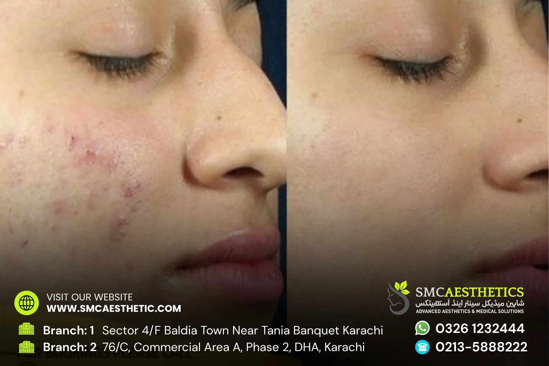 Acne Scars Treatment Before and After Results - SMC Aesthetics Karachi