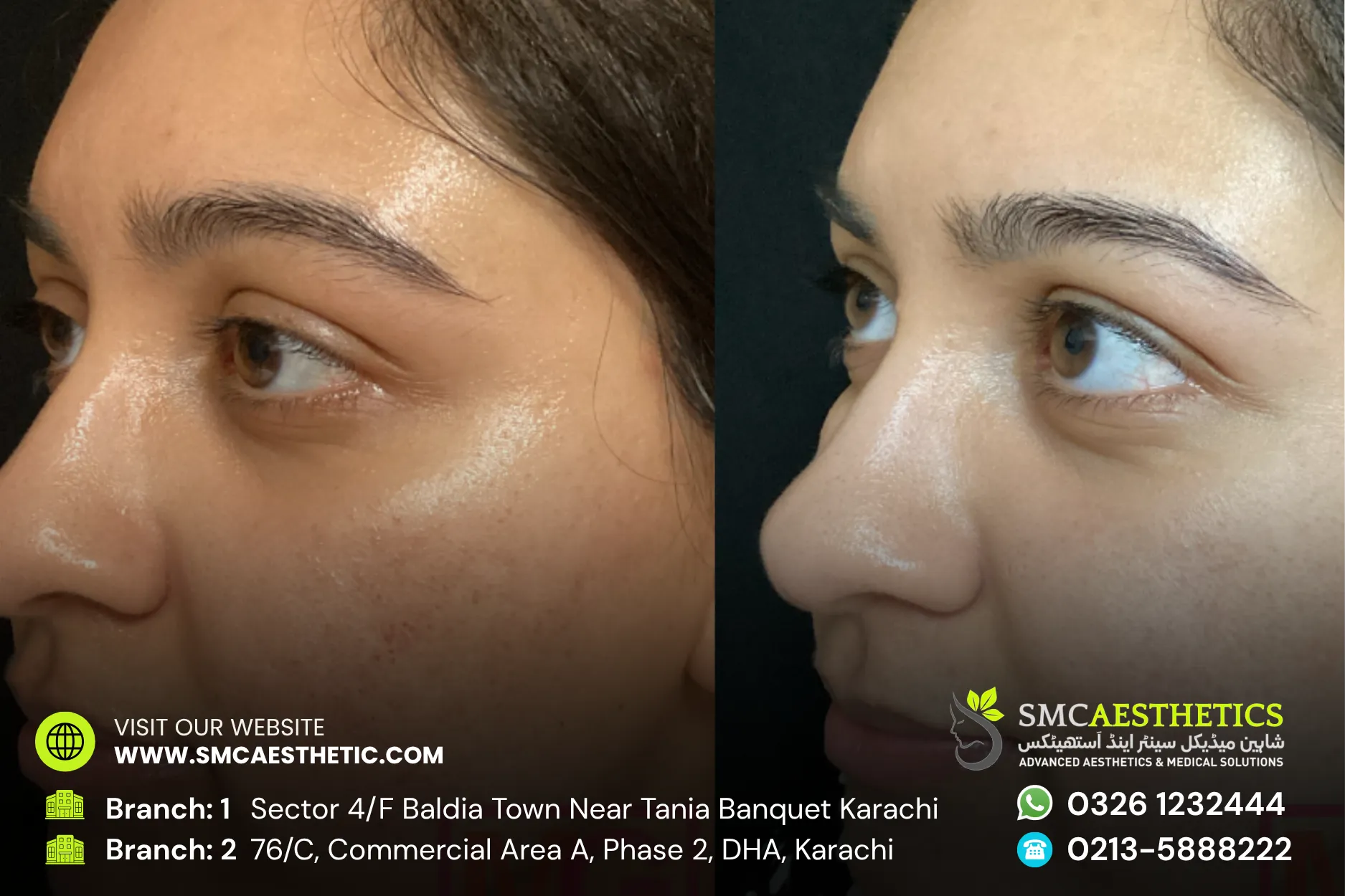 Acne Scars Treatment Before and After Results - SMC Aesthetics Karachi