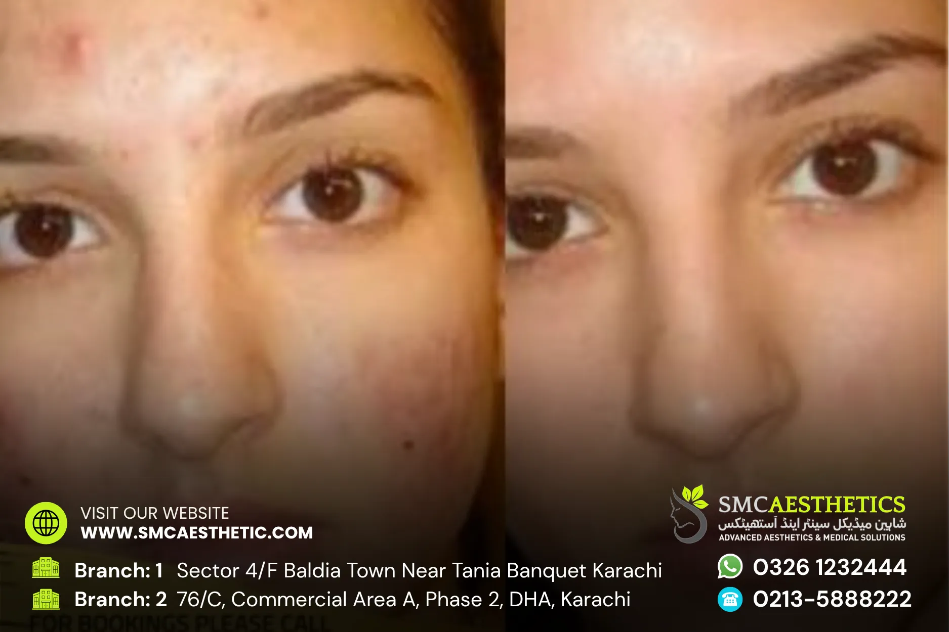 Acne Scars Treatment Before and After Results - SMC Aesthetics Karachi