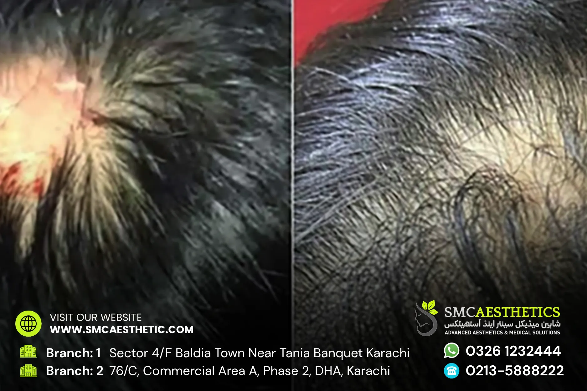 Alopecia Treatment Before and After Results - SMC Aesthetics Karachi