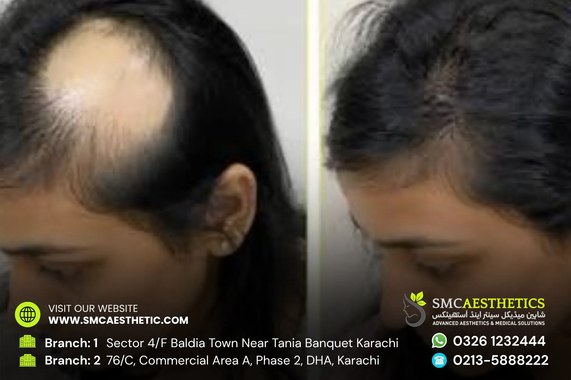 Alopecia Treatment Before and After Results - SMC Aesthetics Karachi