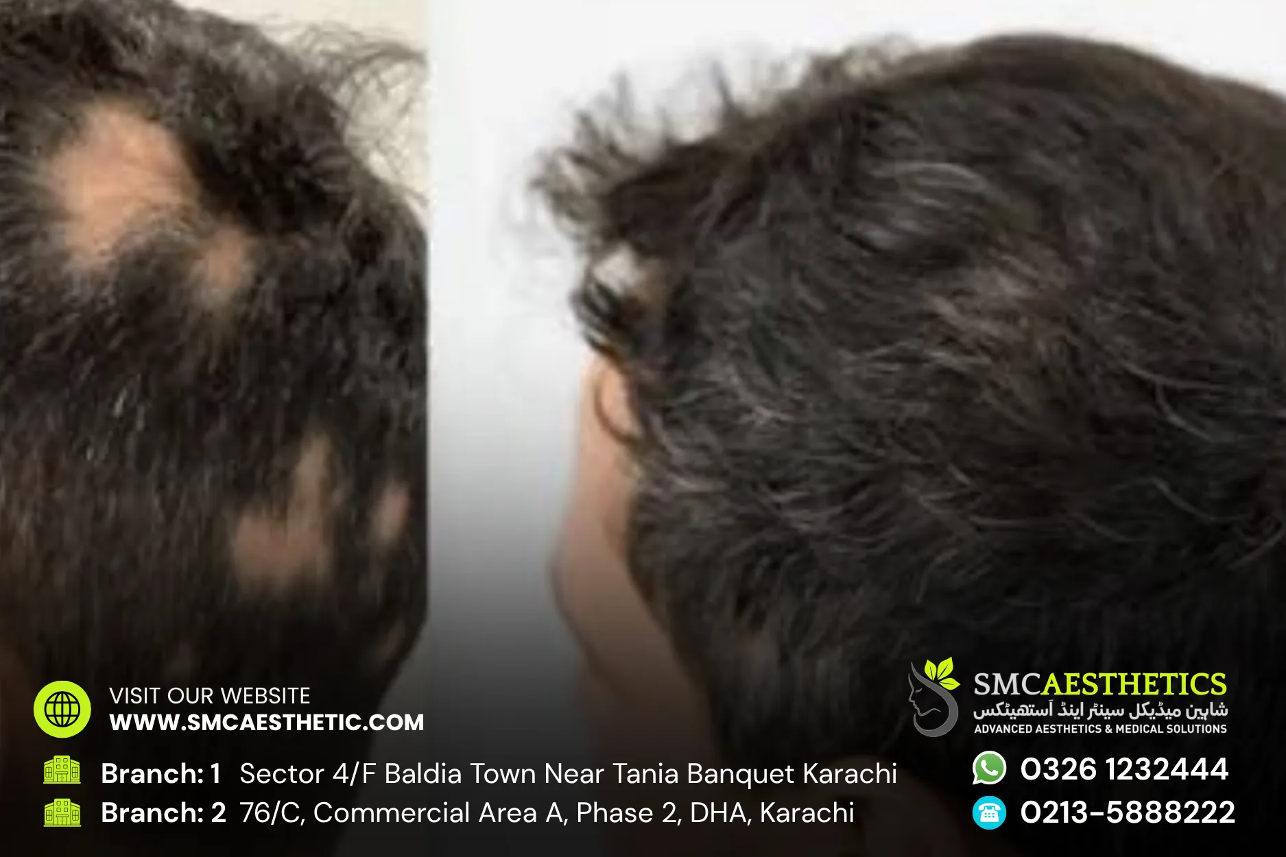 Alopecia Treatment Before and After Results - SMC Aesthetics Karachi