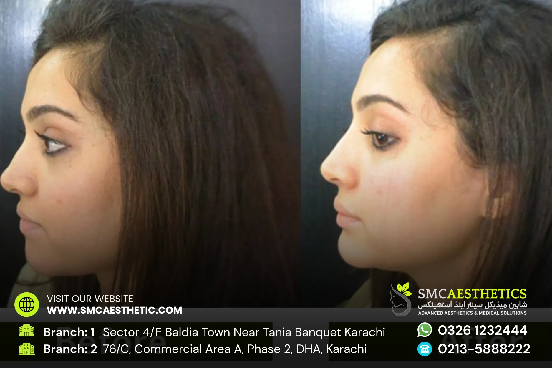 Botox Fillers Before and After Results - SMC Aesthetics Karachi