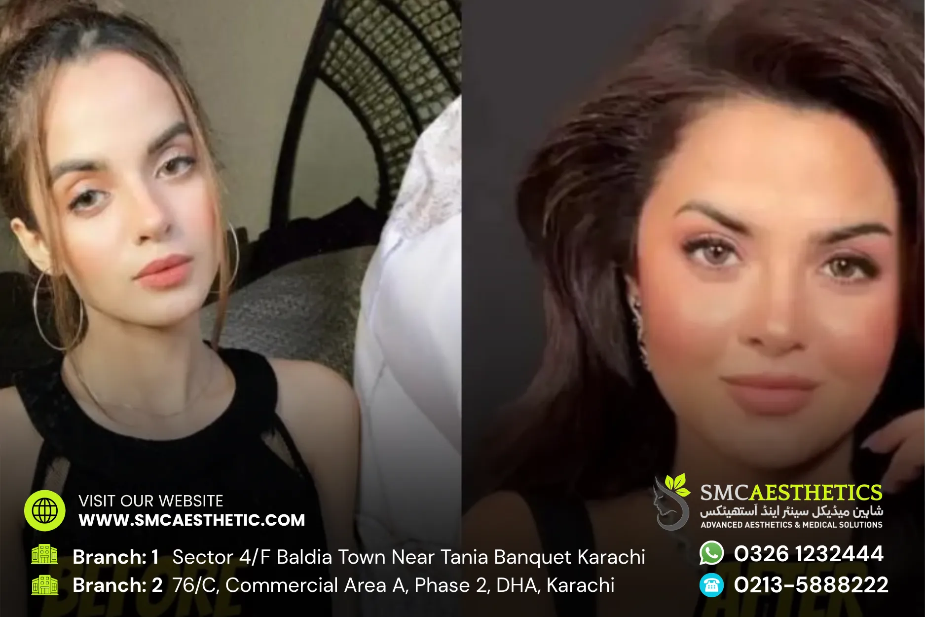 Botox Fillers Before and After Results - SMC Aesthetics Karachi