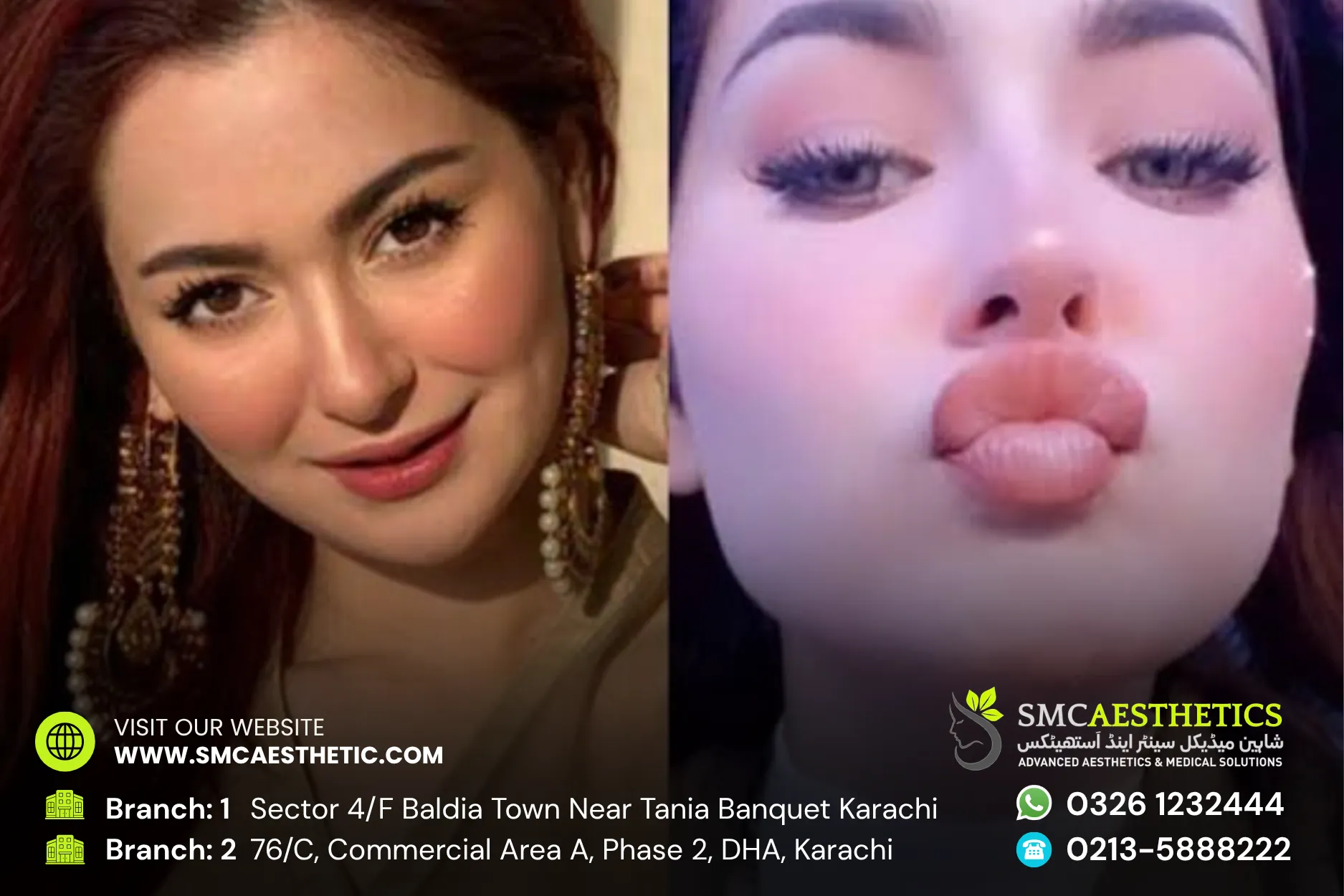 Botox Fillers Before and After Results - SMC Aesthetics Karachi