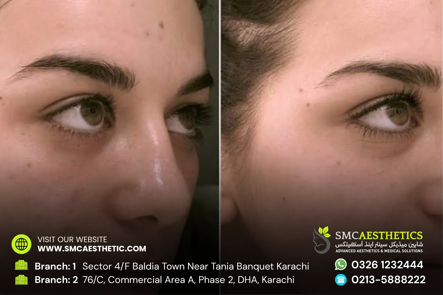 Carbon Facial Before and After Results - SMC Aesthetics Karachi