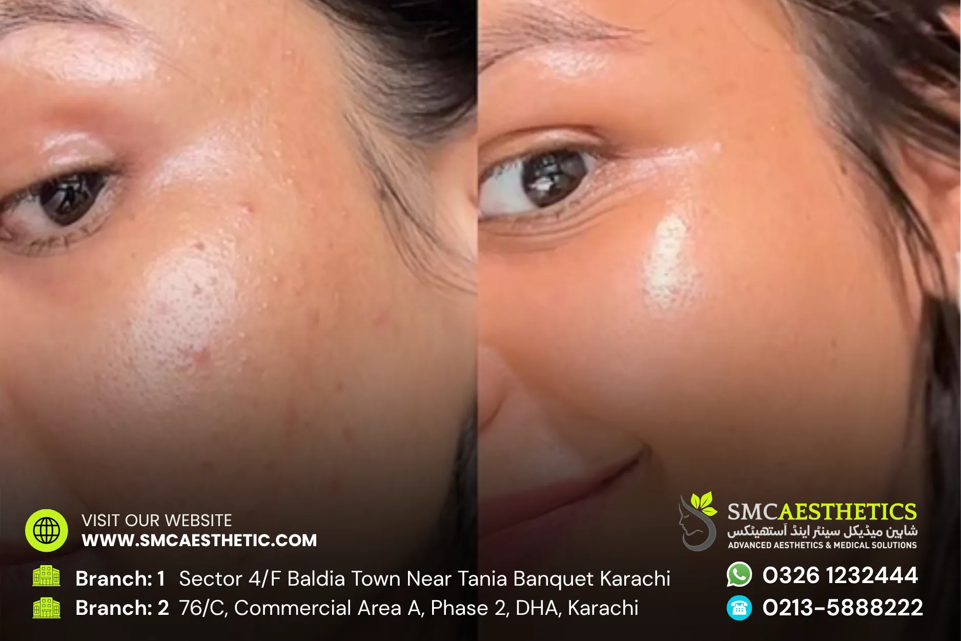 Carbon Facial Before and After Results - SMC Aesthetics Karachi