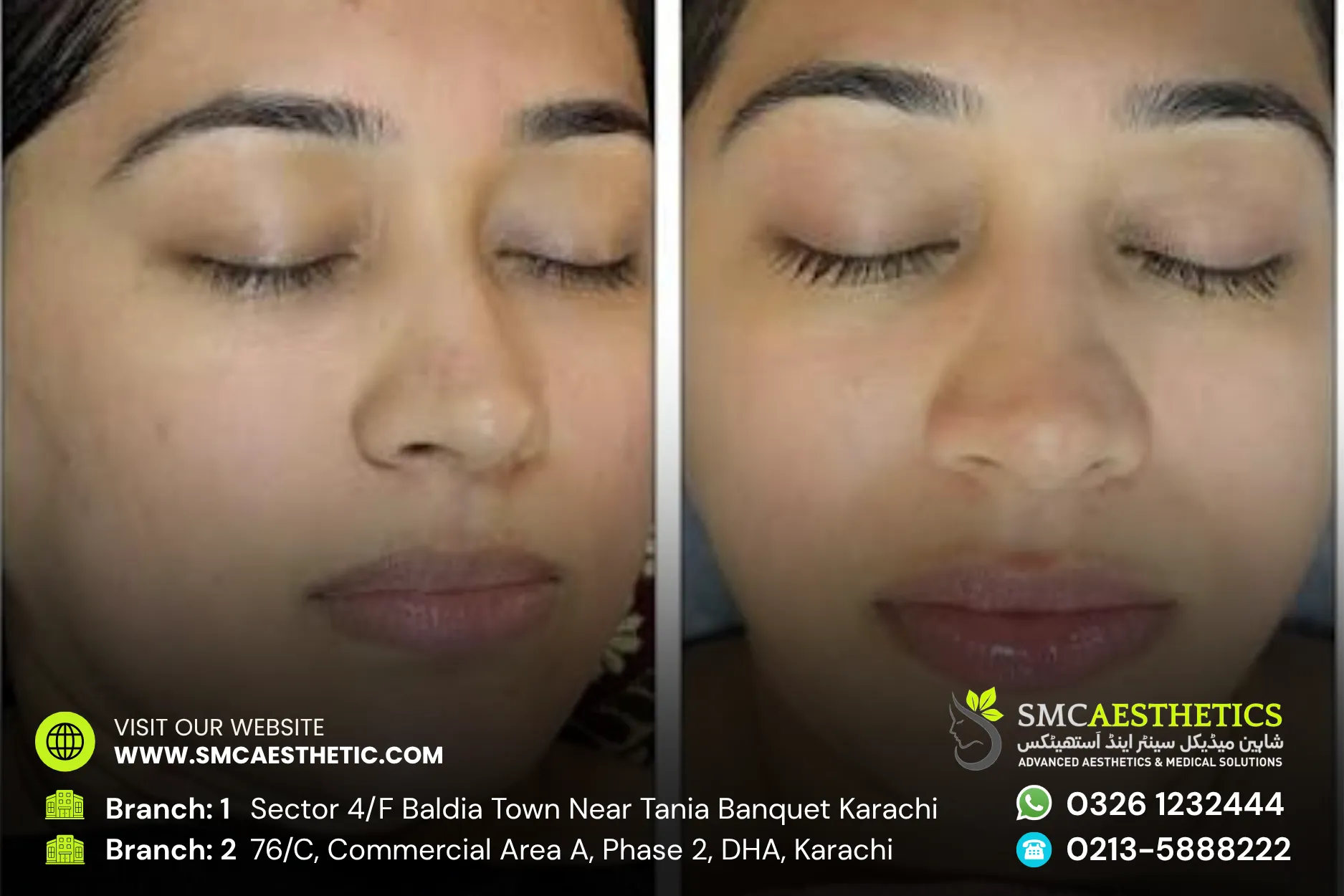 Carbon Facial Before and After Results - SMC Aesthetics Karachi