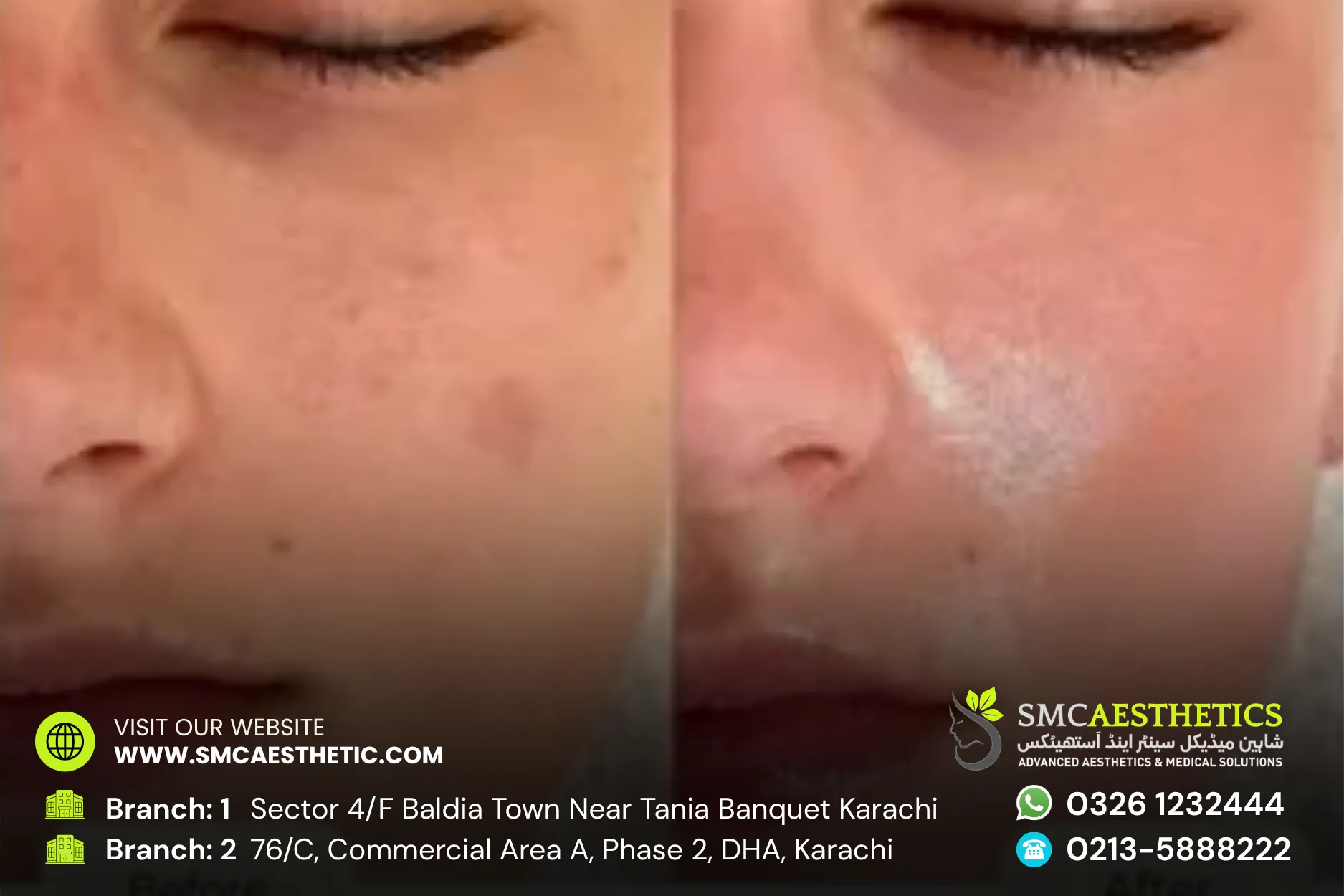 Chemical Peel Before and After Results - SMC Aesthetics Karachi