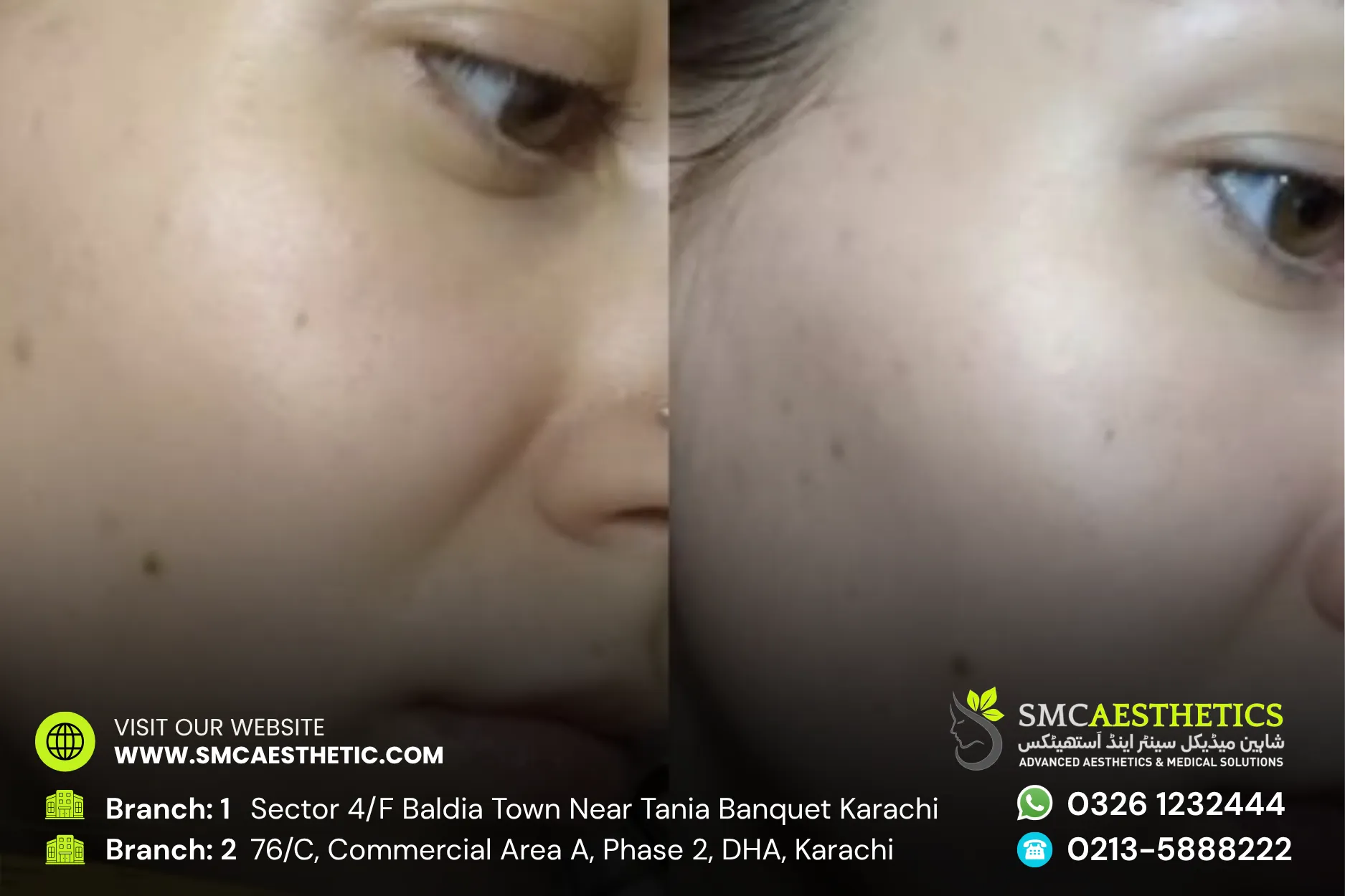 Chemical Peel Before and After Results - SMC Aesthetics Karachi