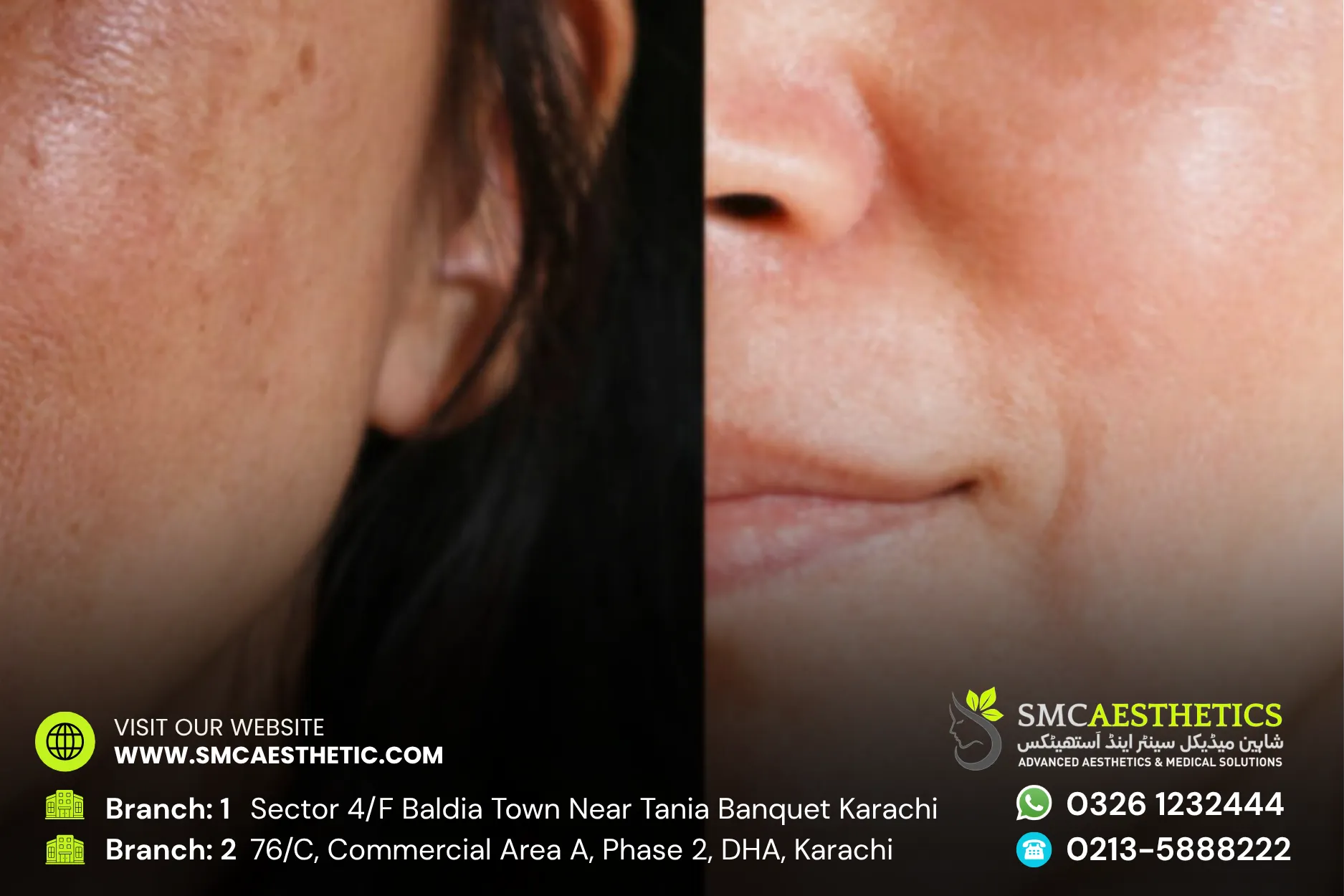 Chemical Peel Before and After Results - SMC Aesthetics Karachi