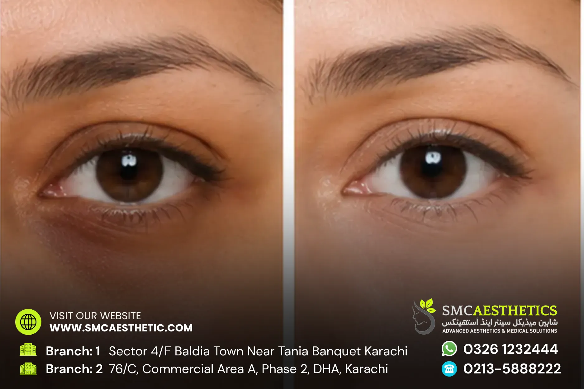 Dark Circles Treatment Before and After Results - SMC Aesthetics Karachi