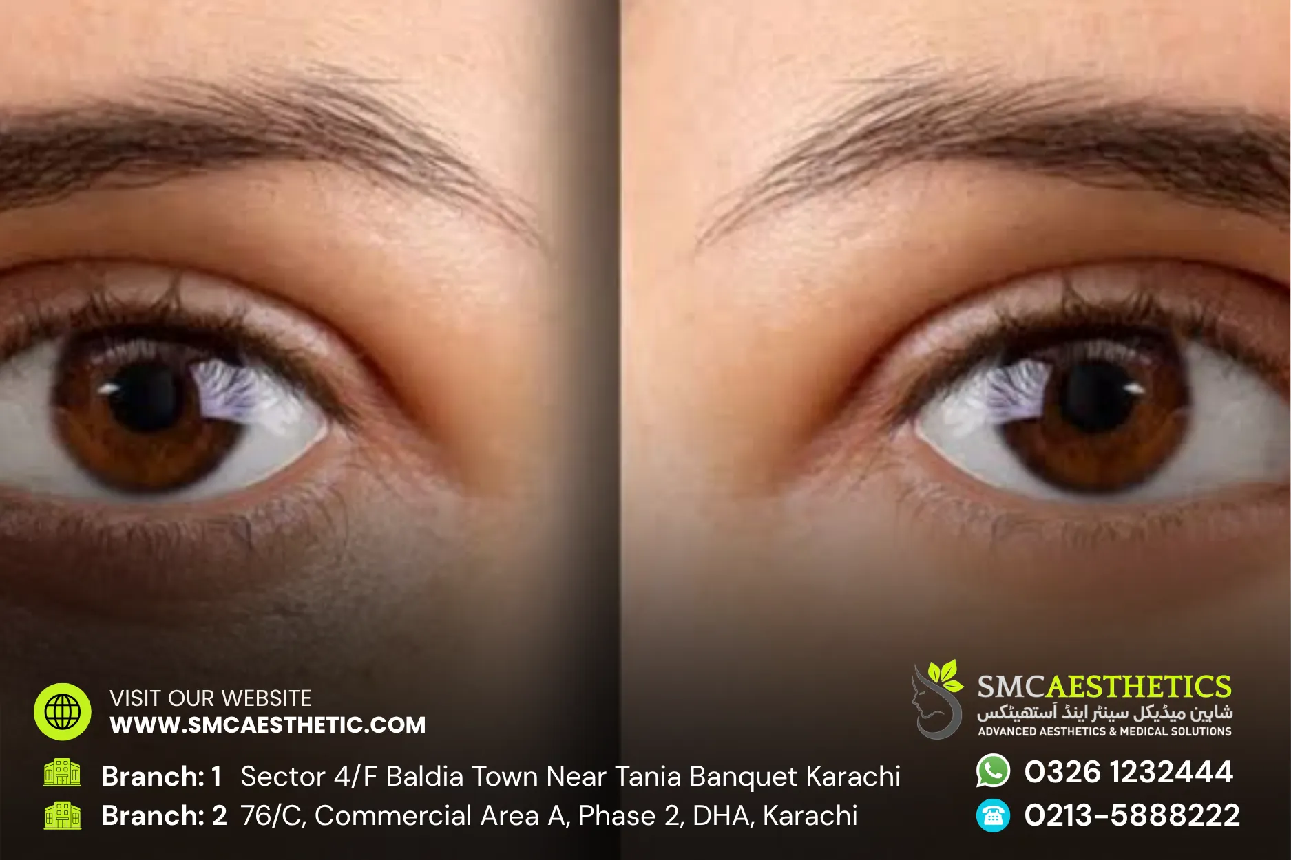 Dark Circles Treatment Before and After Results - SMC Aesthetics Karachi