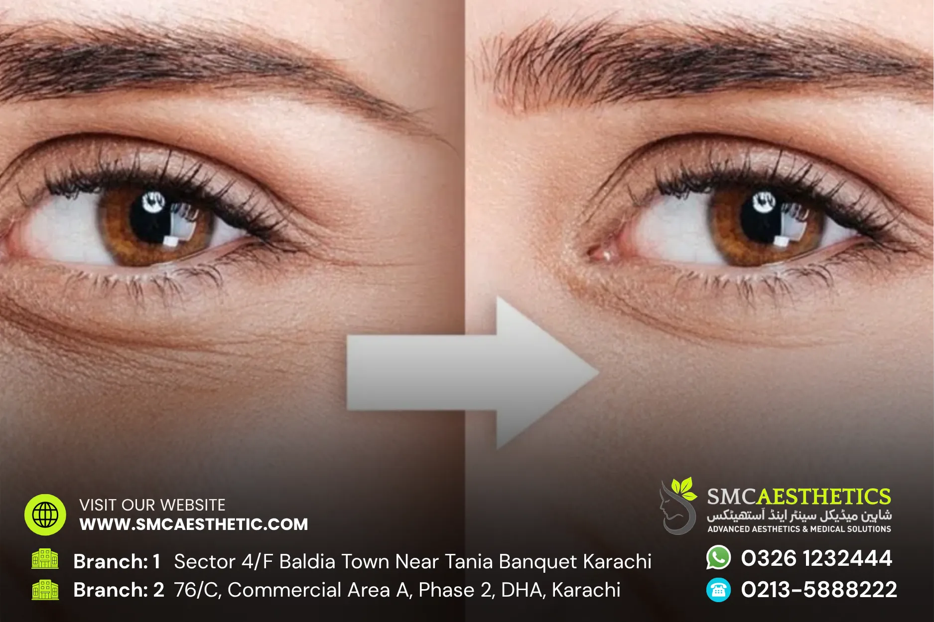 Dark Circles Treatment Before and After Results - SMC Aesthetics Karachi