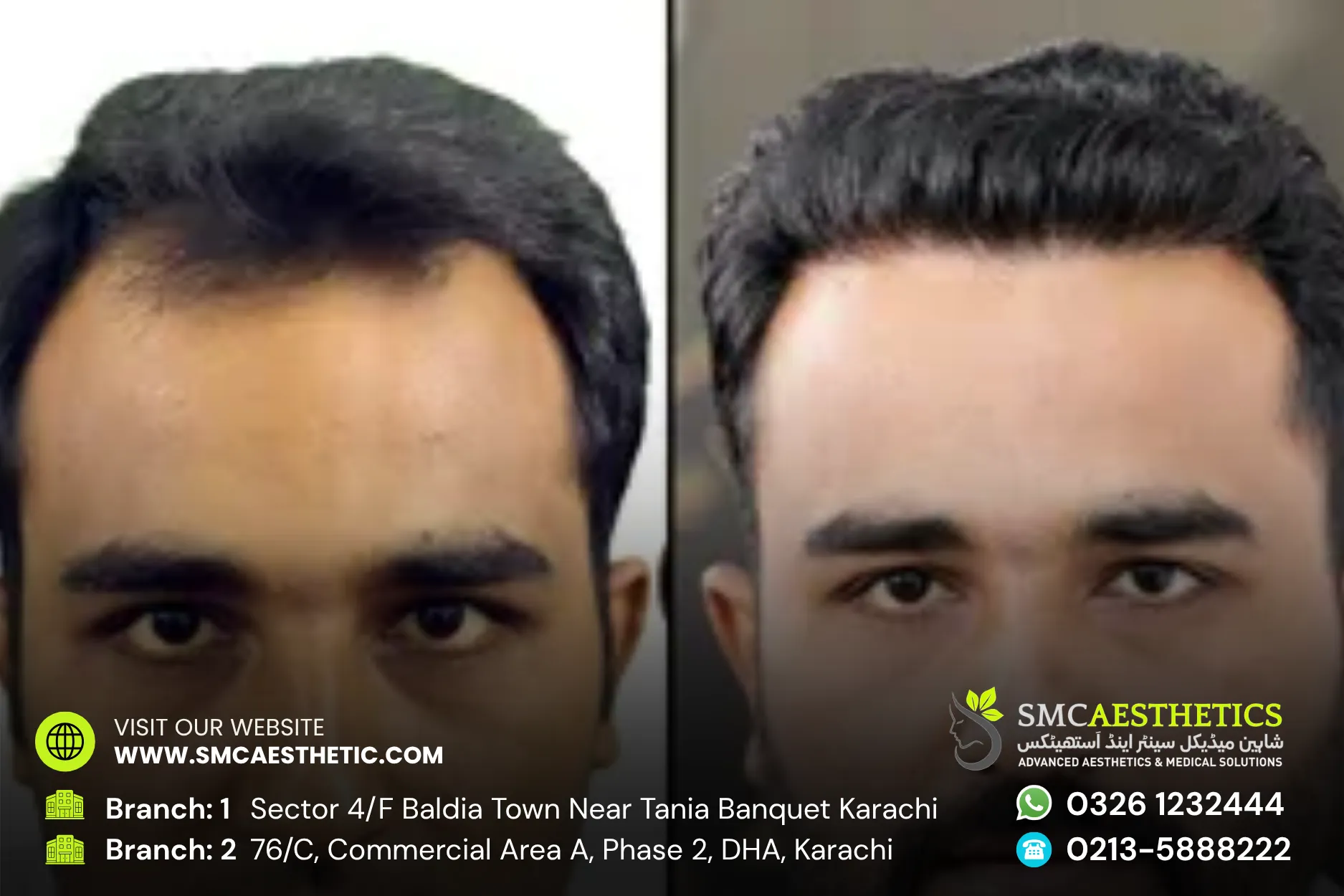 Dhi Hair Transplant Before and After Results - SMC Aesthetics Karachi