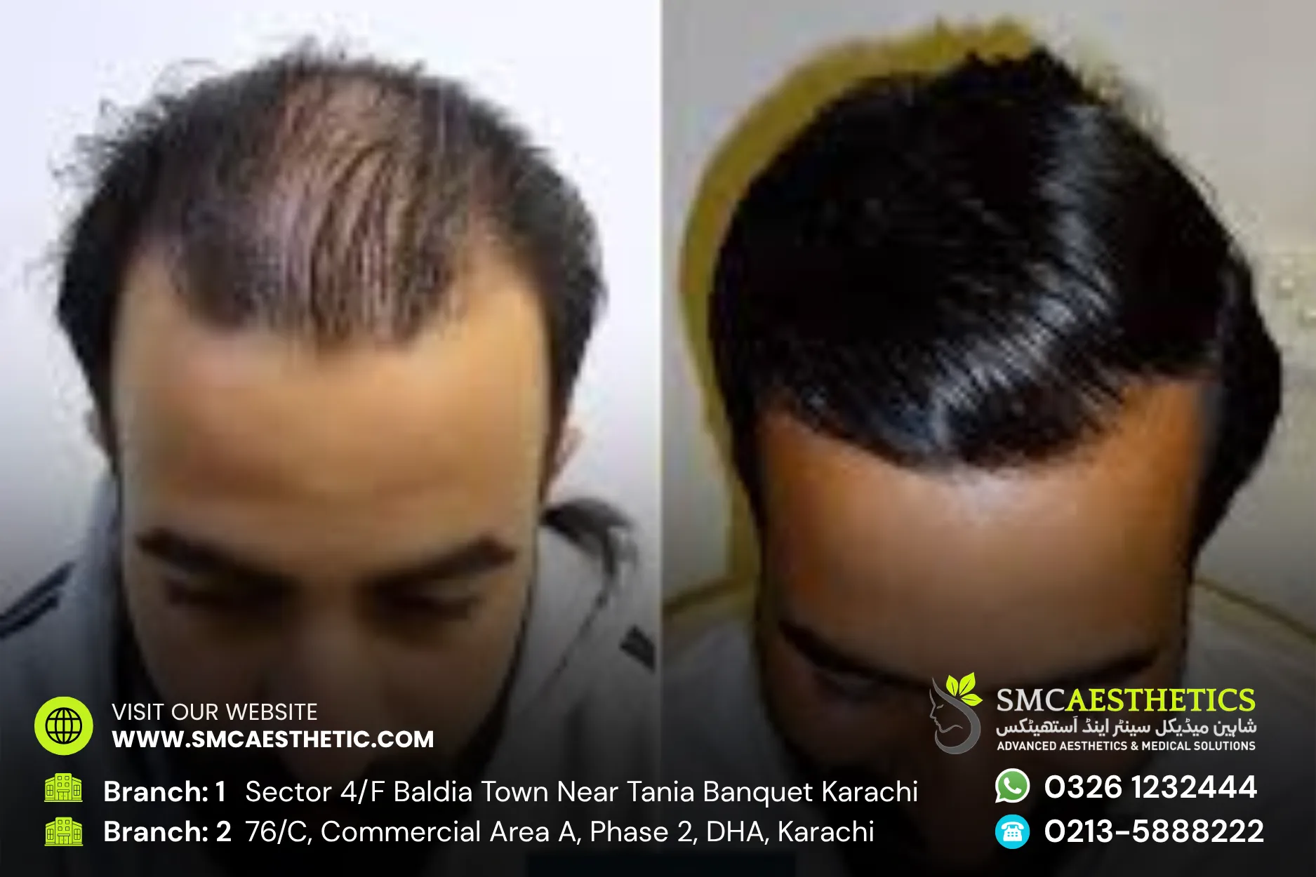 Dhi Hair Transplant Before and After Results - SMC Aesthetics Karachi