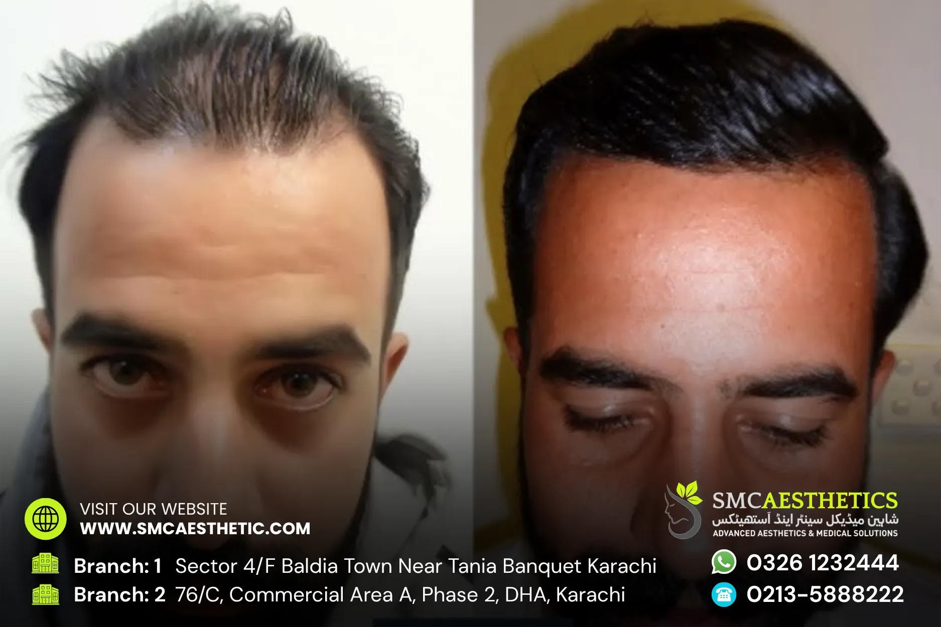 Dhi Hair Transplant Before and After Results - SMC Aesthetics Karachi