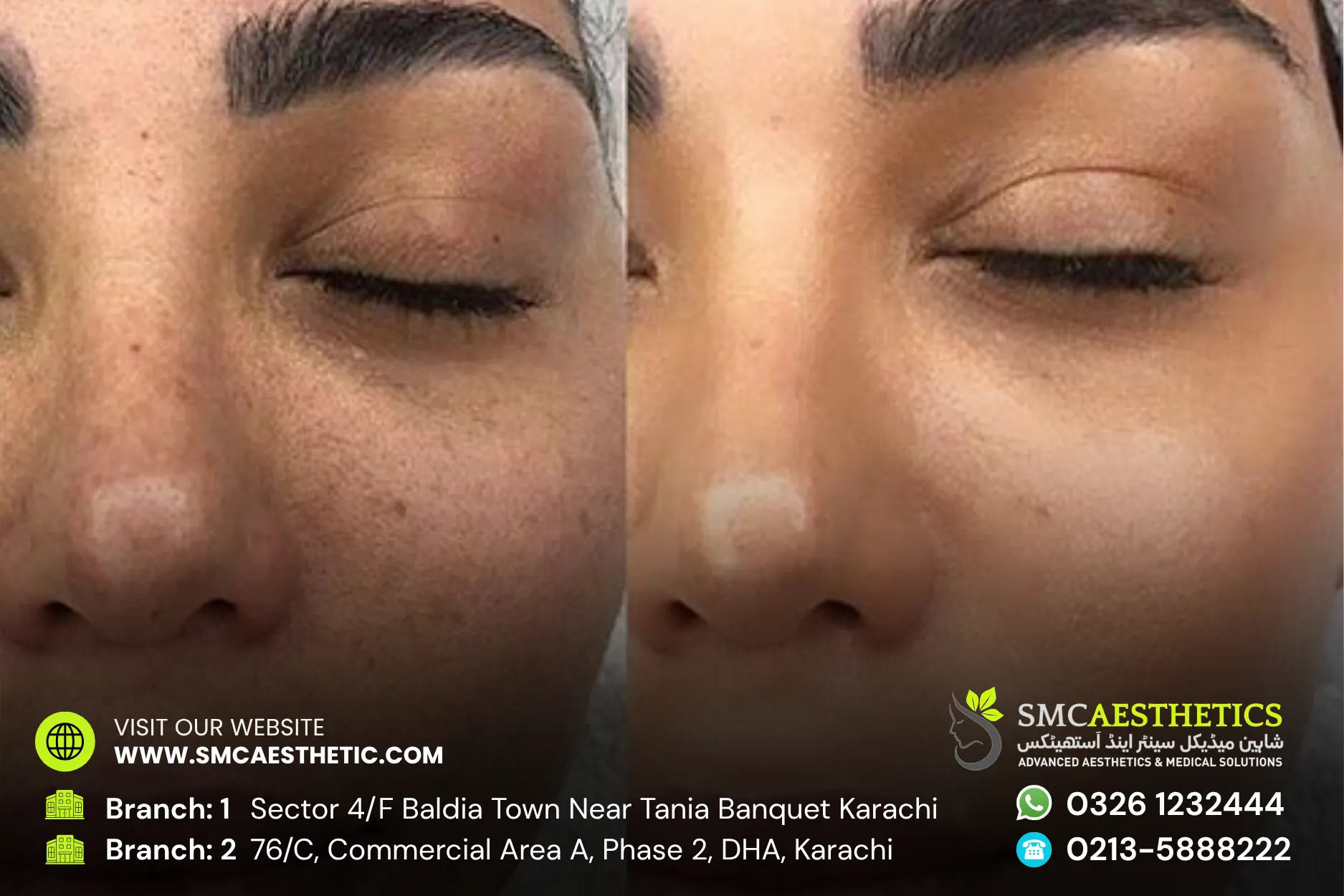 Before After Results