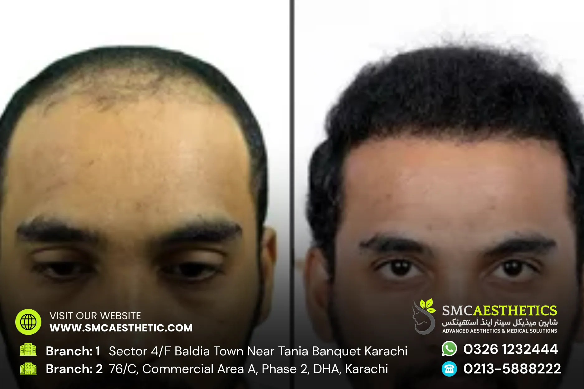 Fue Hair Transplant Before and After Results - SMC Aesthetics Karachi