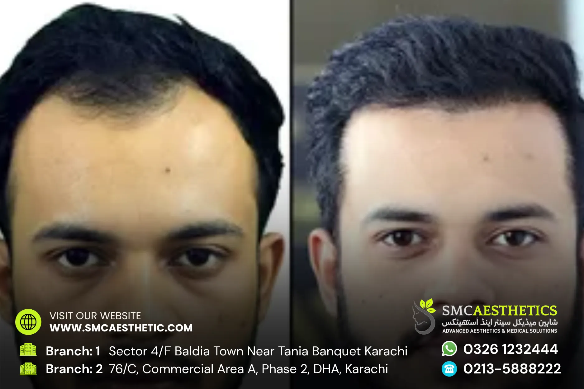 Fue Hair Transplant Before and After Results - SMC Aesthetics Karachi