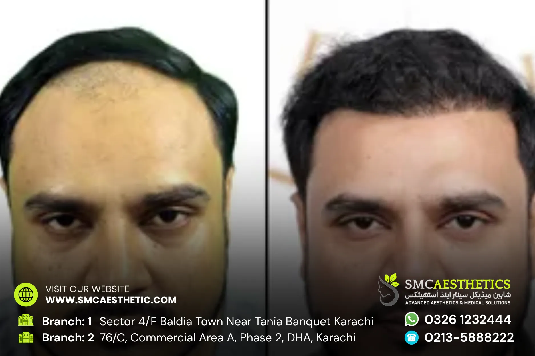 Fue Hair Transplant Before and After Results - SMC Aesthetics Karachi