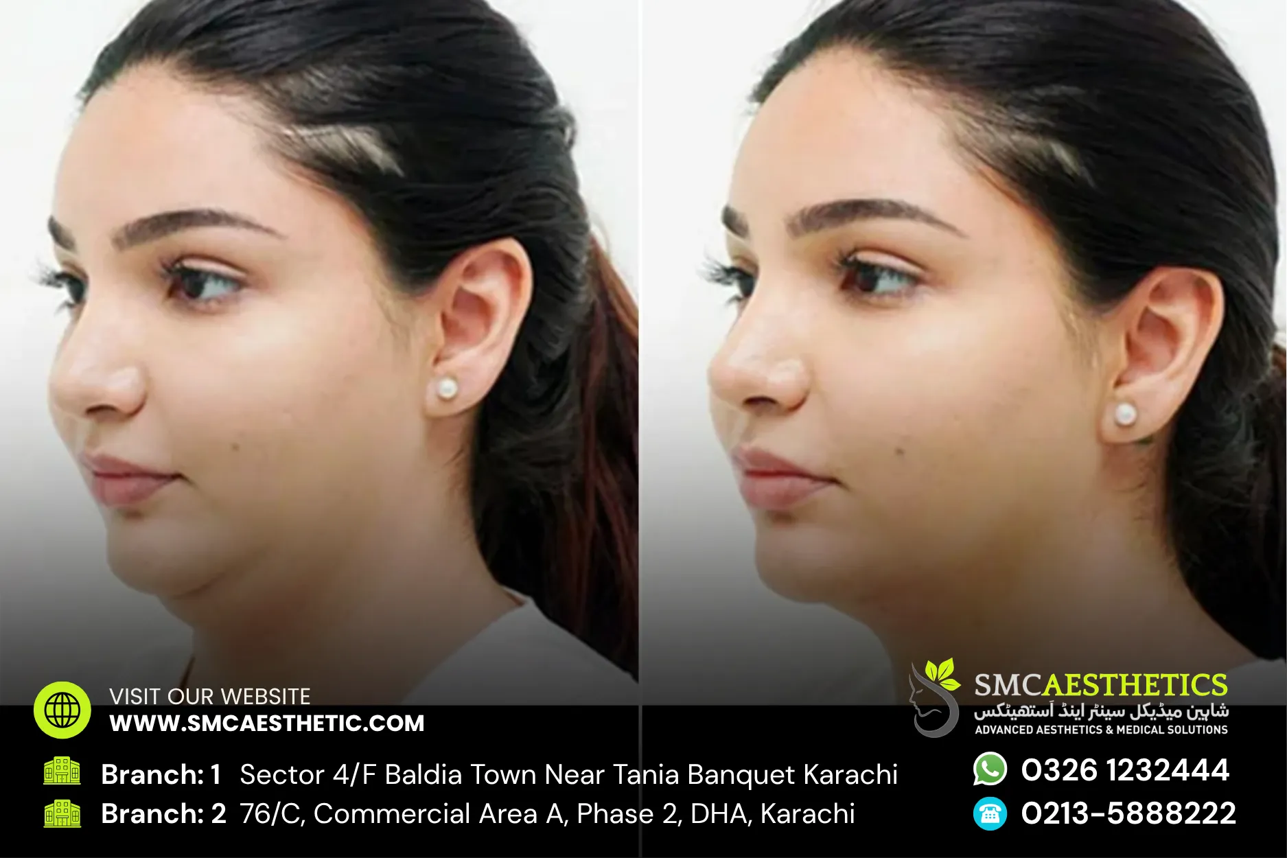 Hifu Treatment Before and After Results - SMC Aesthetics Karachi