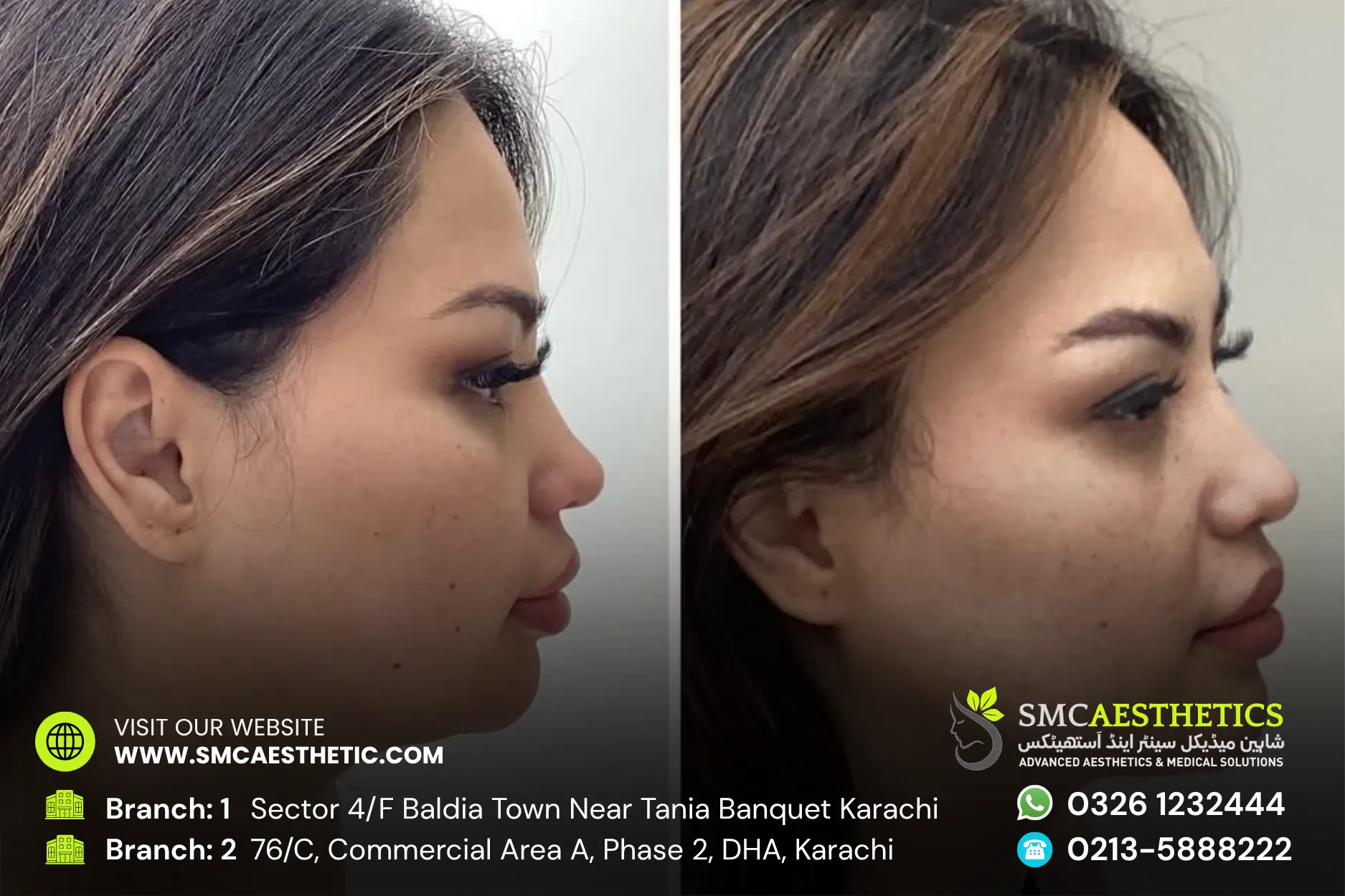 Hifu Treatment Before and After Results - SMC Aesthetics Karachi