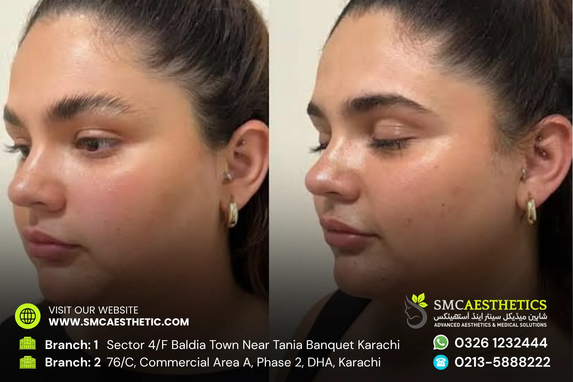 Hifu Treatment Before and After Results - SMC Aesthetics Karachi