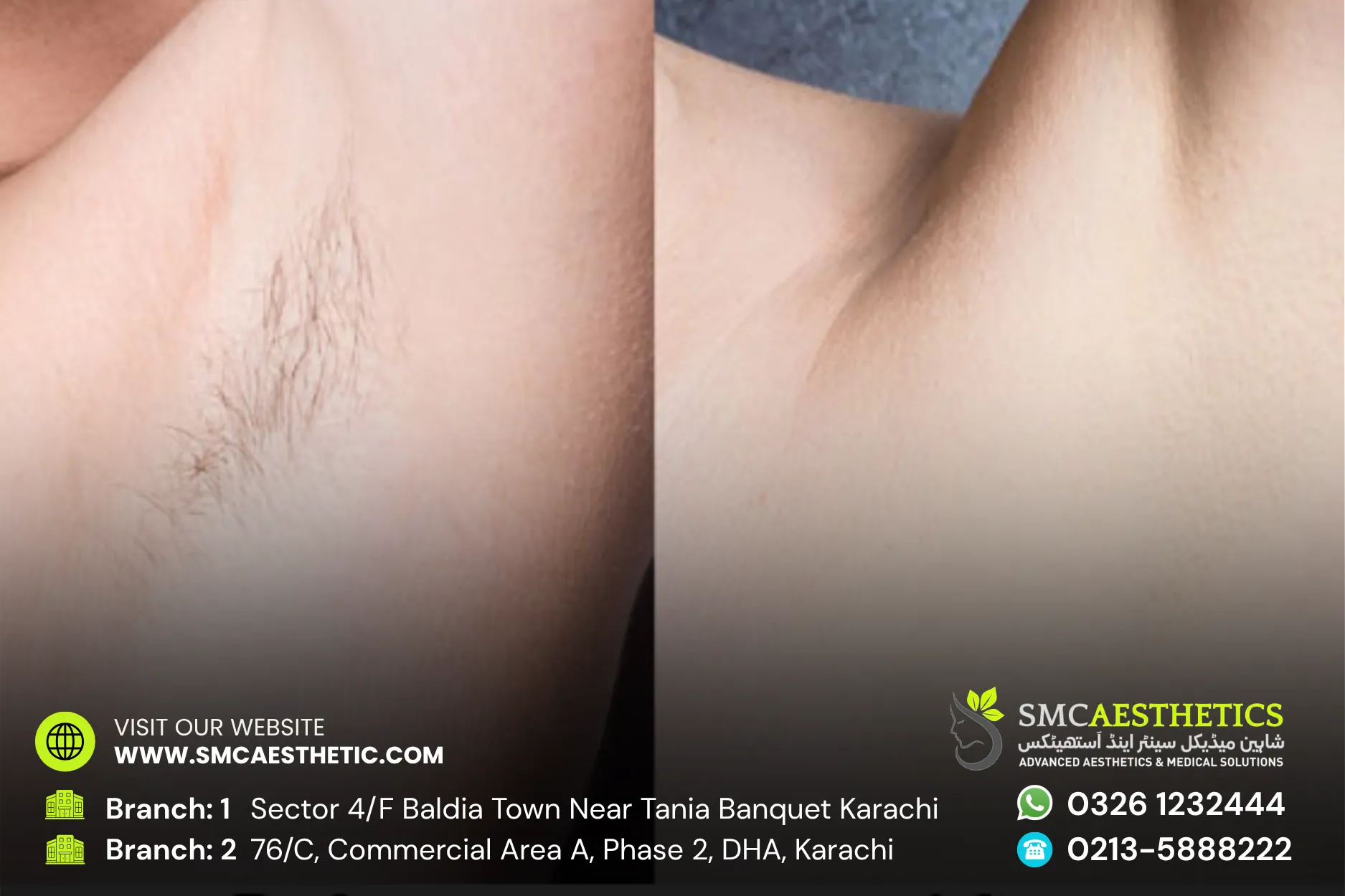 Laser Hair Removal Before and After Results - SMC Aesthetics Karachi
