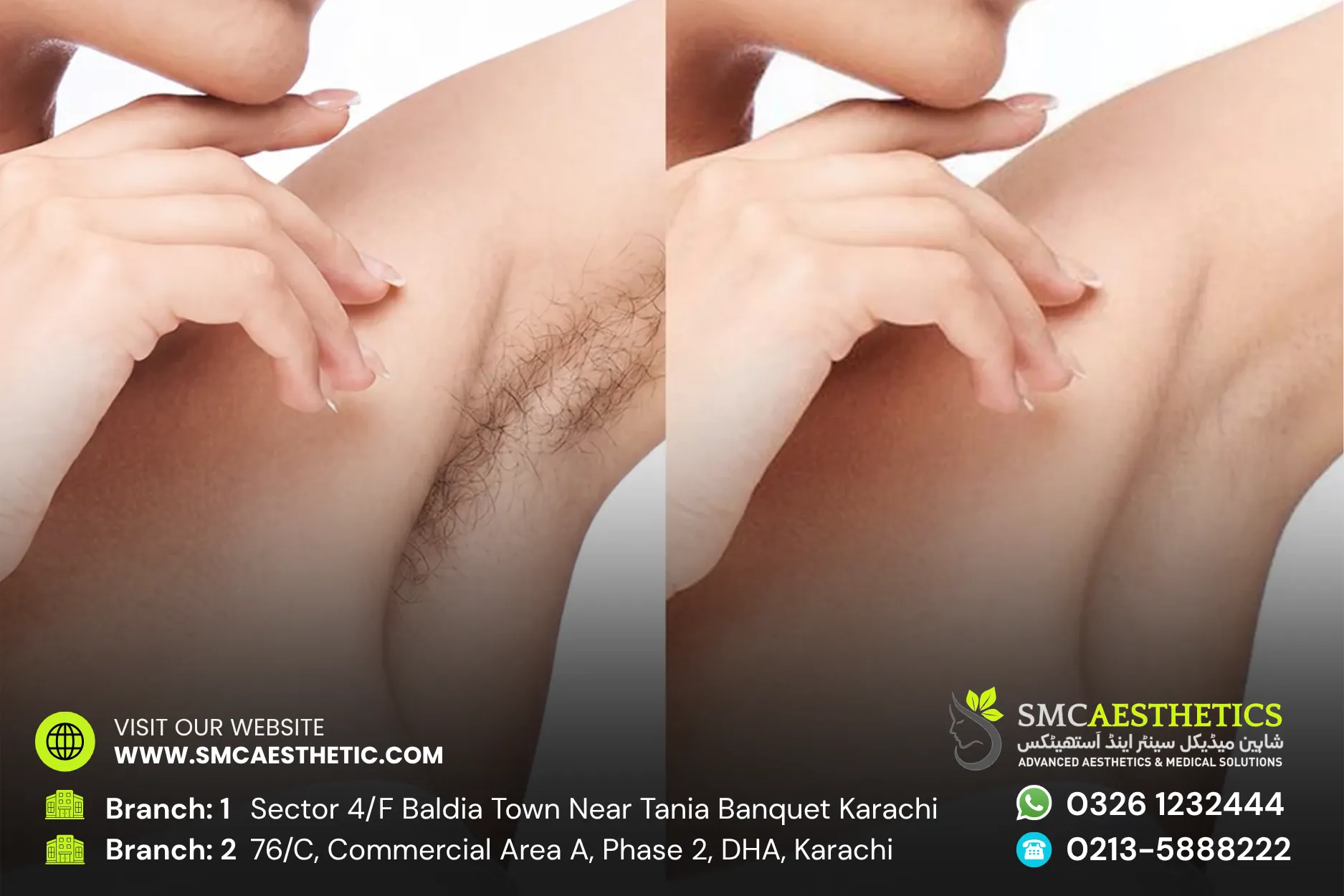 Laser Hair Removal Before and After Results - SMC Aesthetics Karachi