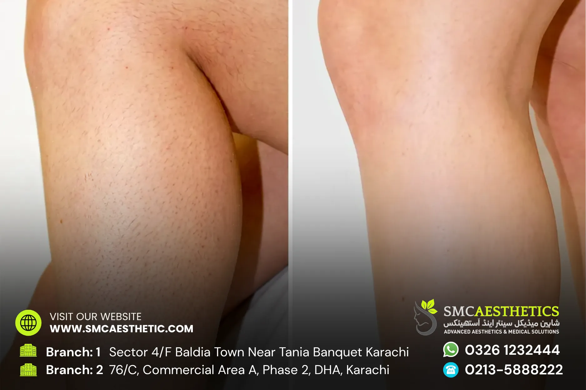 Laser Hair Removal Before and After Results - SMC Aesthetics Karachi