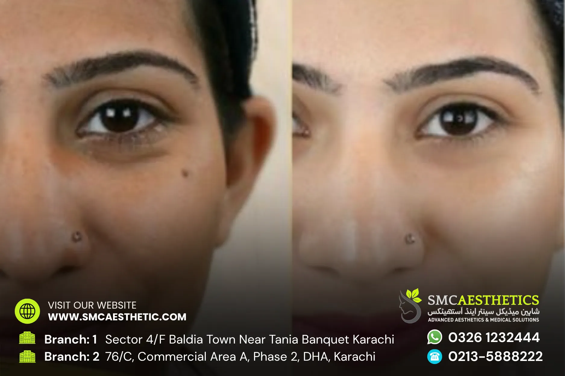 Before After Results