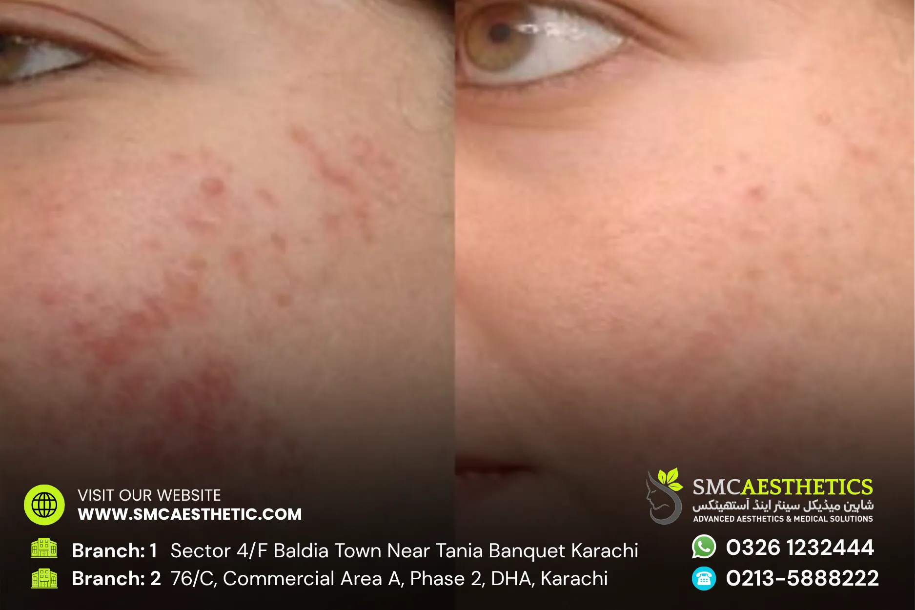Before After Results