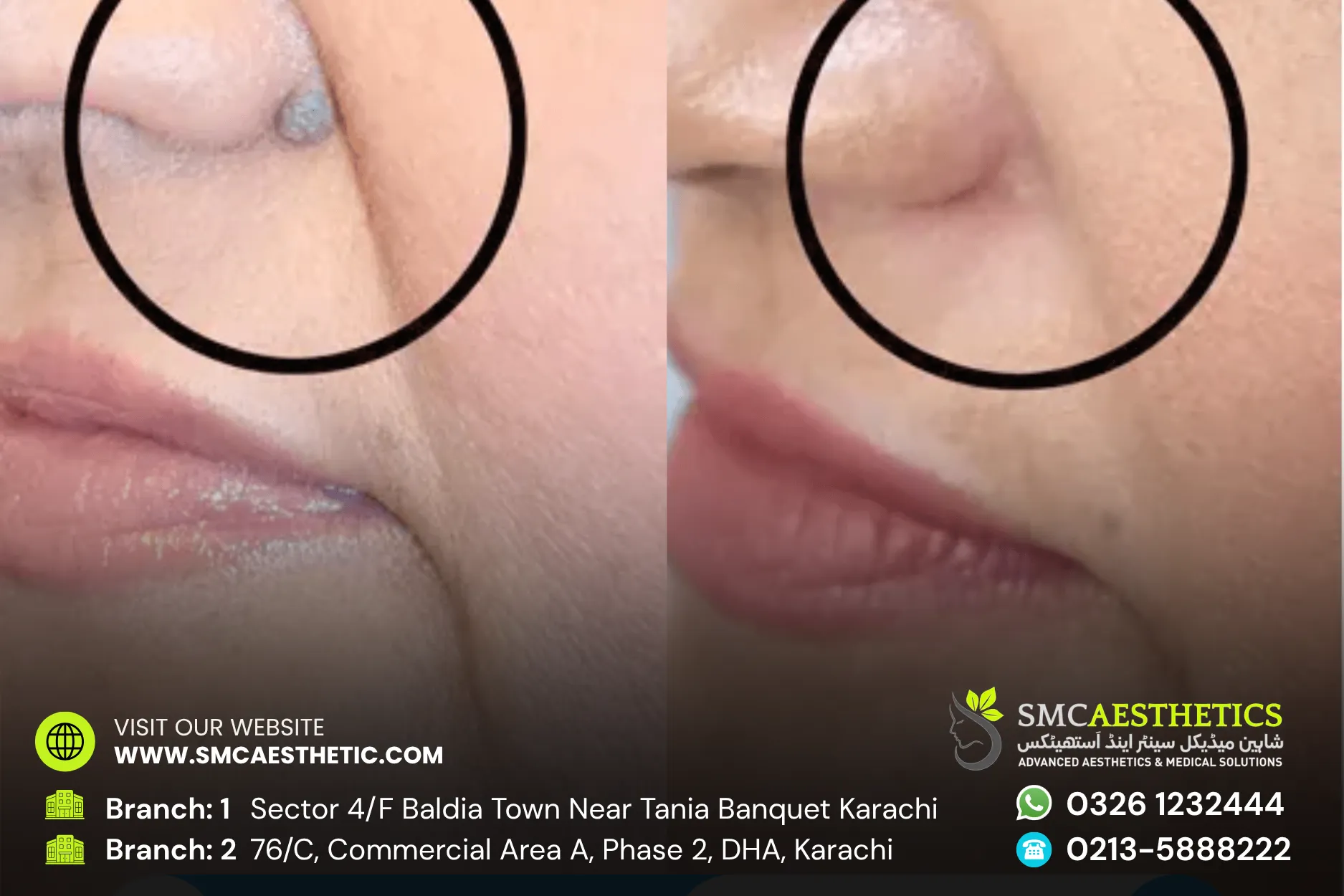 Moles Warts Removal Before and After Results - SMC Aesthetics Karachi