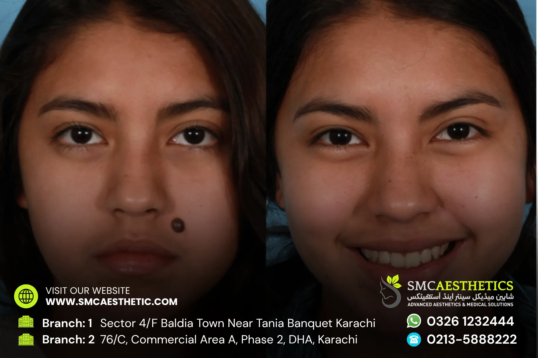 Moles Warts Removal Before and After Results - SMC Aesthetics Karachi