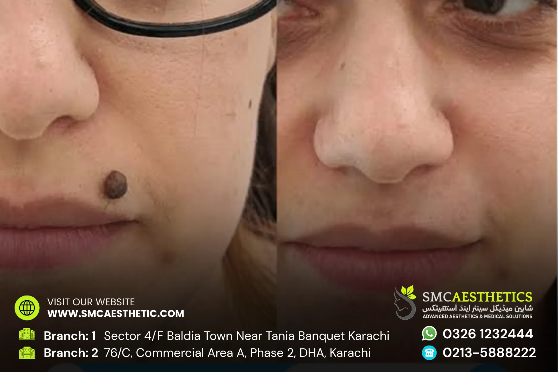 Moles Warts Removal Before and After Results - SMC Aesthetics Karachi