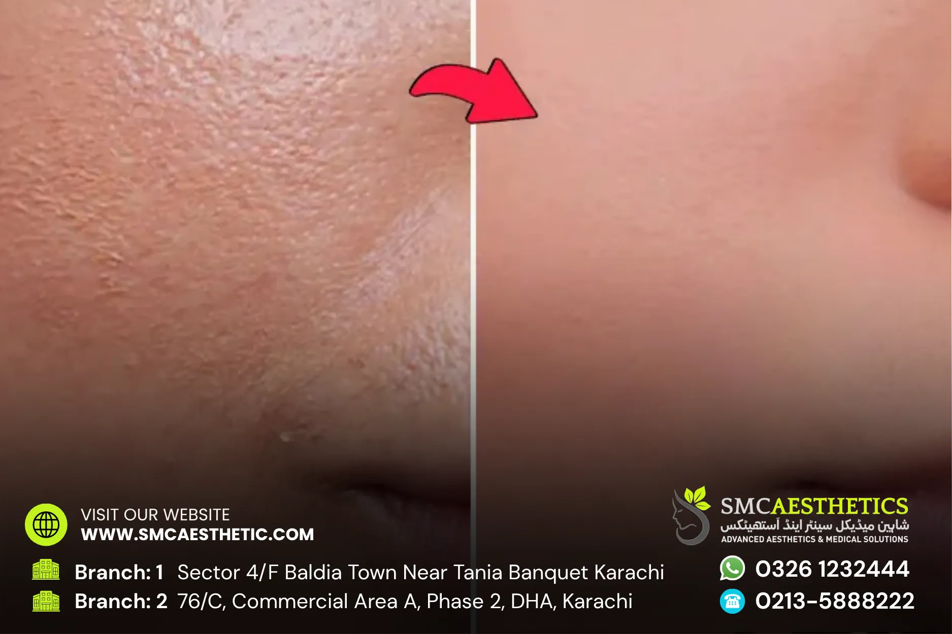 Open Pores Treatment Before and After Results - SMC Aesthetics Karachi