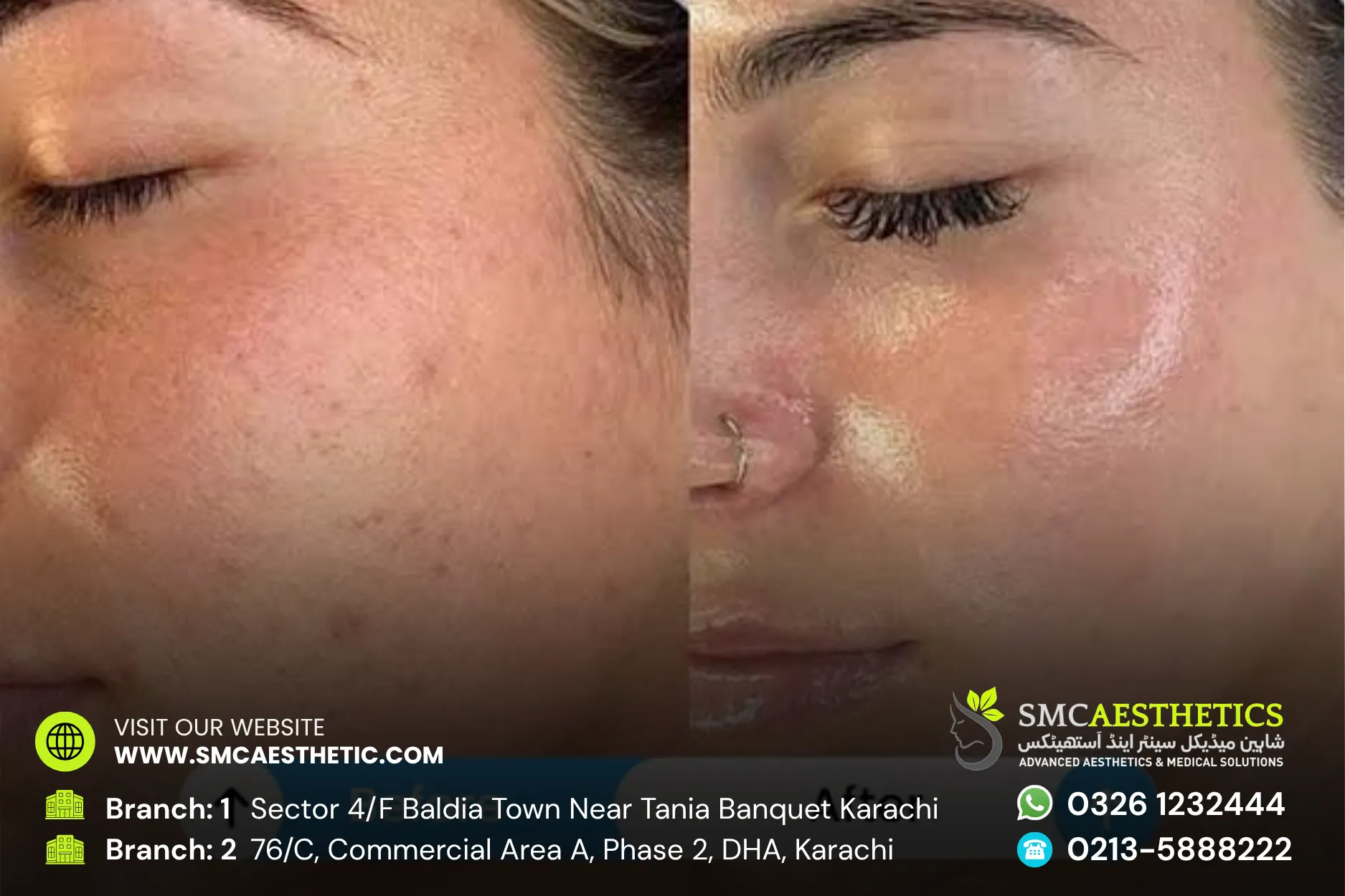Open Pores Treatment Before and After Results - SMC Aesthetics Karachi