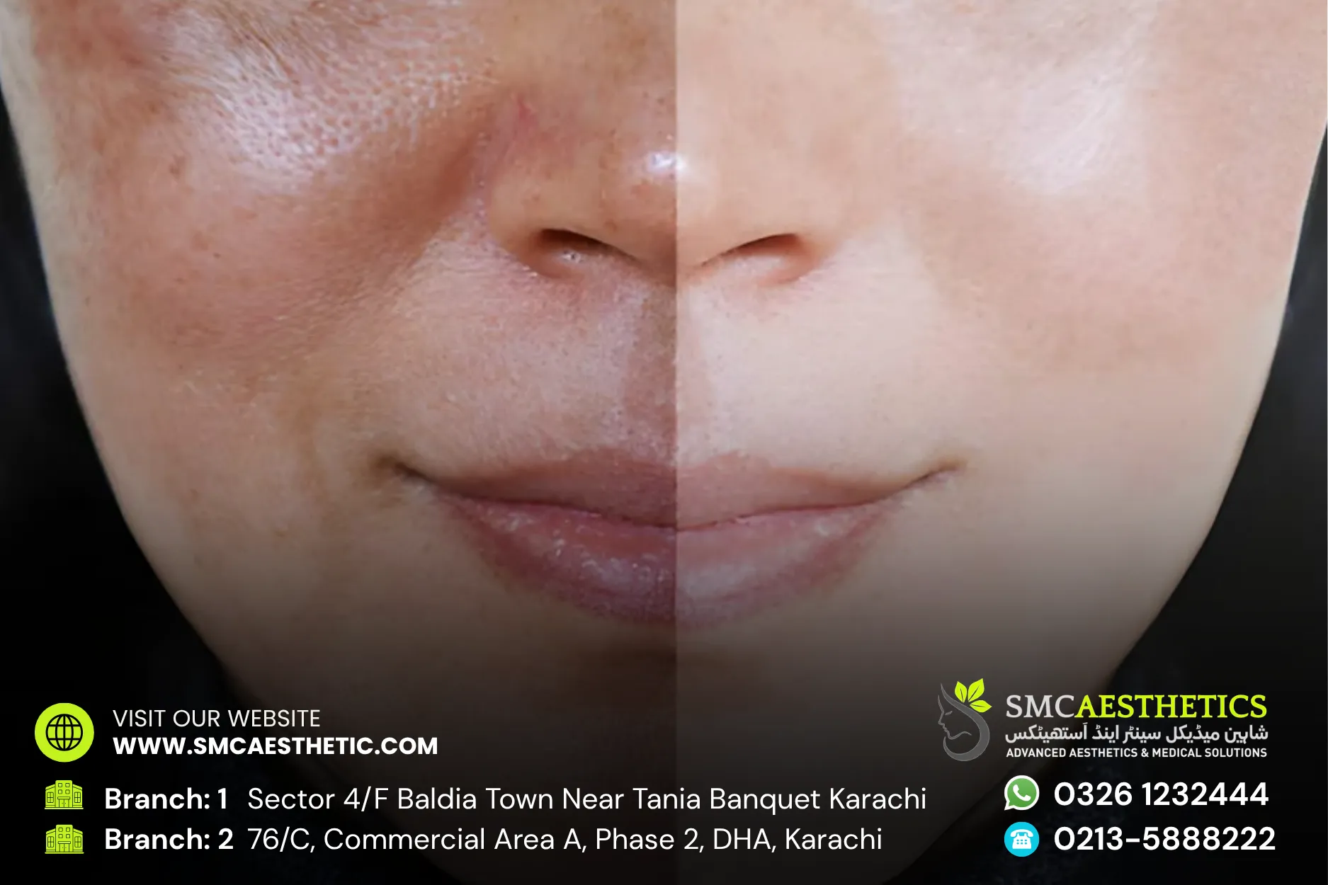 Open Pores Treatment Before and After Results - SMC Aesthetics Karachi