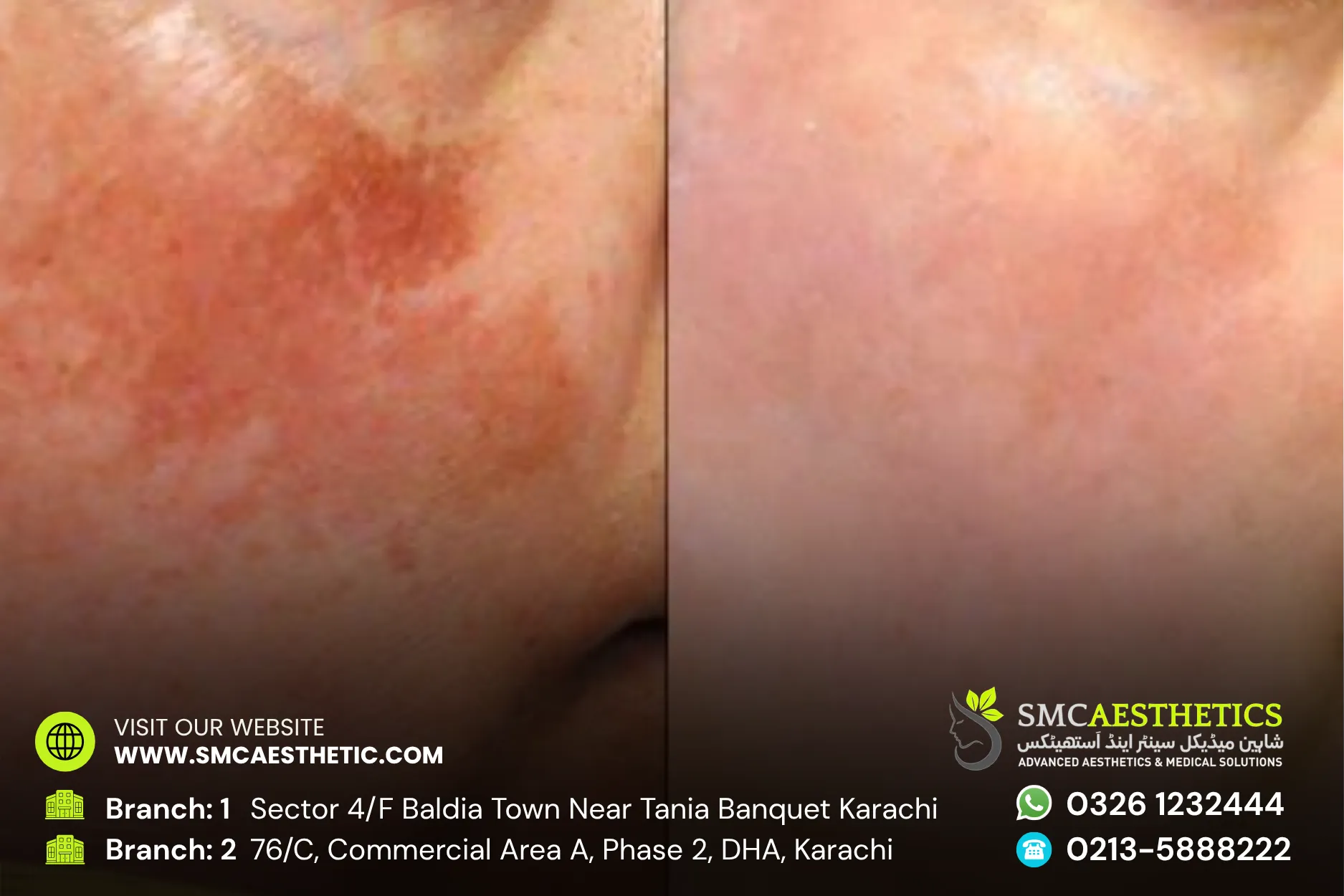 Pigmentation Treatment Before and After Results - SMC Aesthetics Karachi