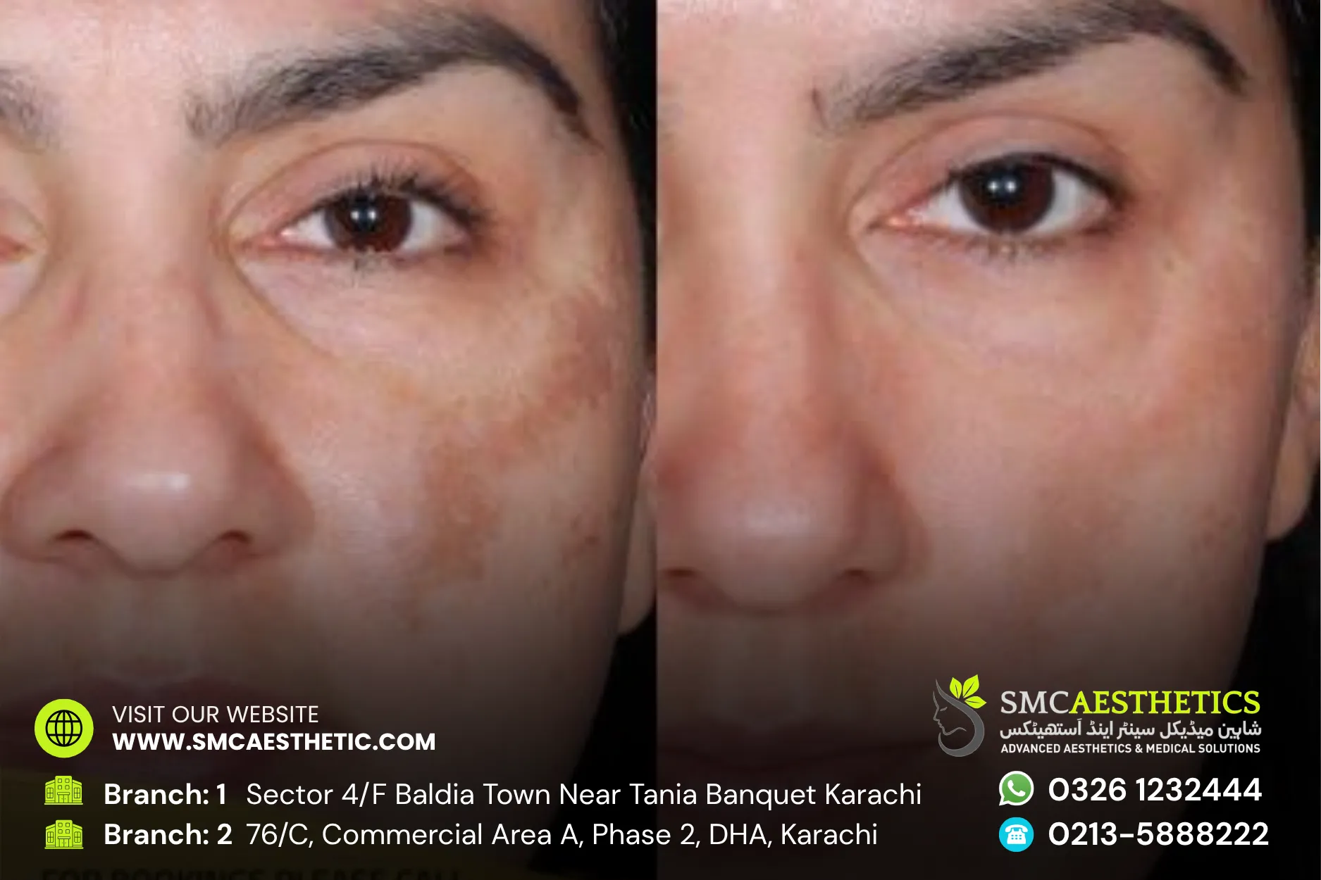 Pigmentation Treatment Before and After Results - SMC Aesthetics Karachi