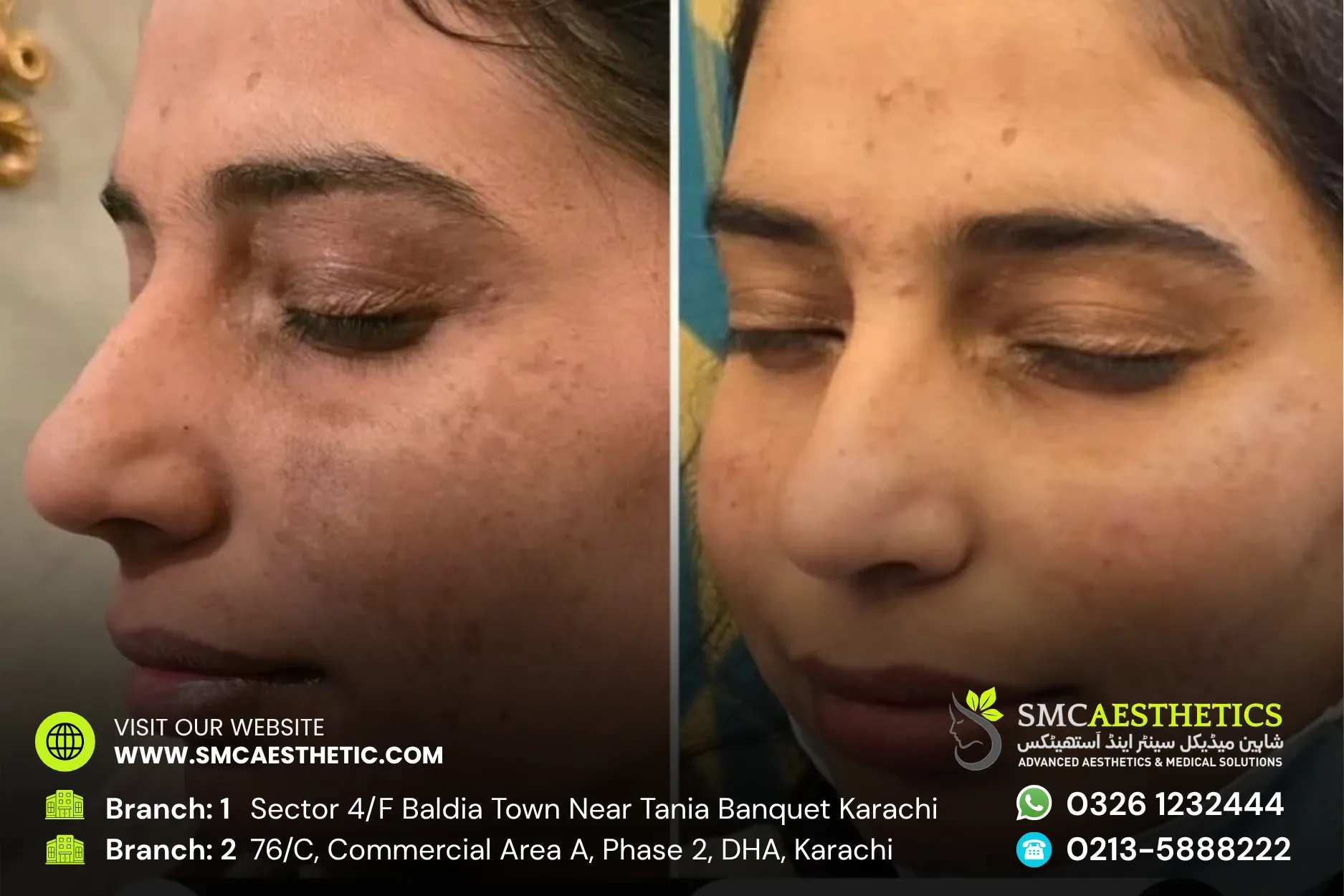 Pigmentation Treatment Before and After Results - SMC Aesthetics Karachi