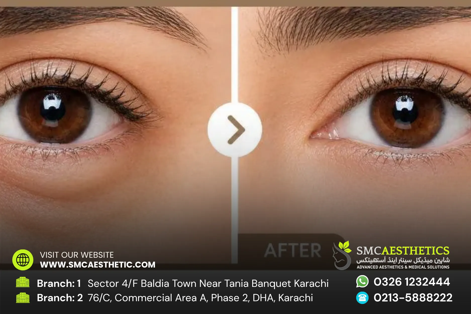 Puffy Eyes Treatment Before and After Results - SMC Aesthetics Karachi