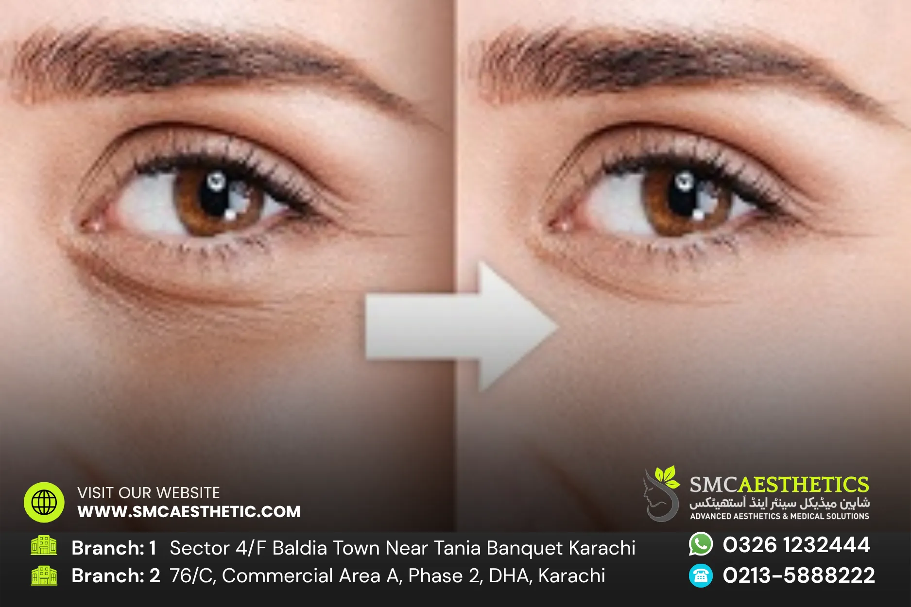 Puffy Eyes Treatment Before and After Results - SMC Aesthetics Karachi