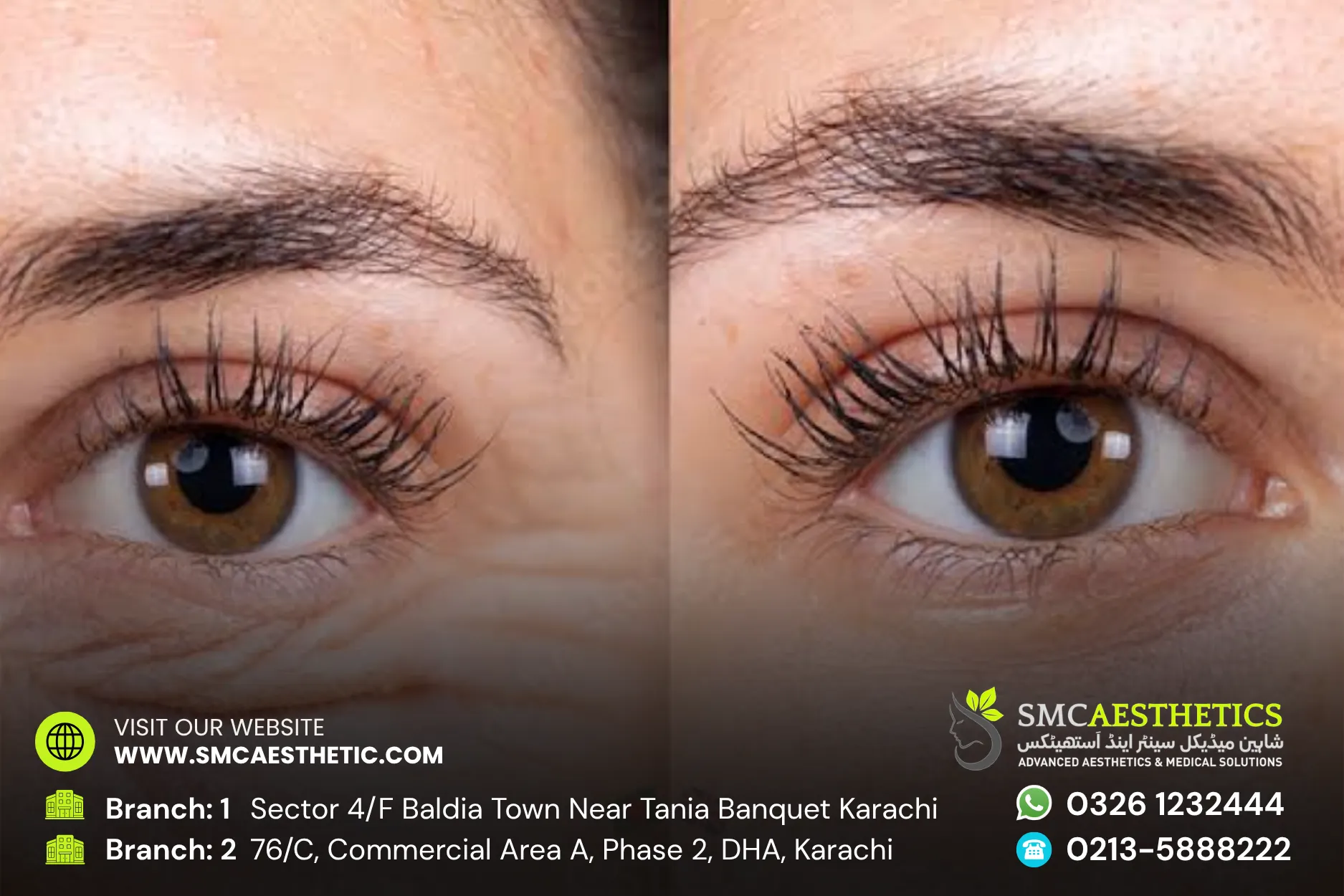 Puffy Eyes Treatment Before and After Results - SMC Aesthetics Karachi