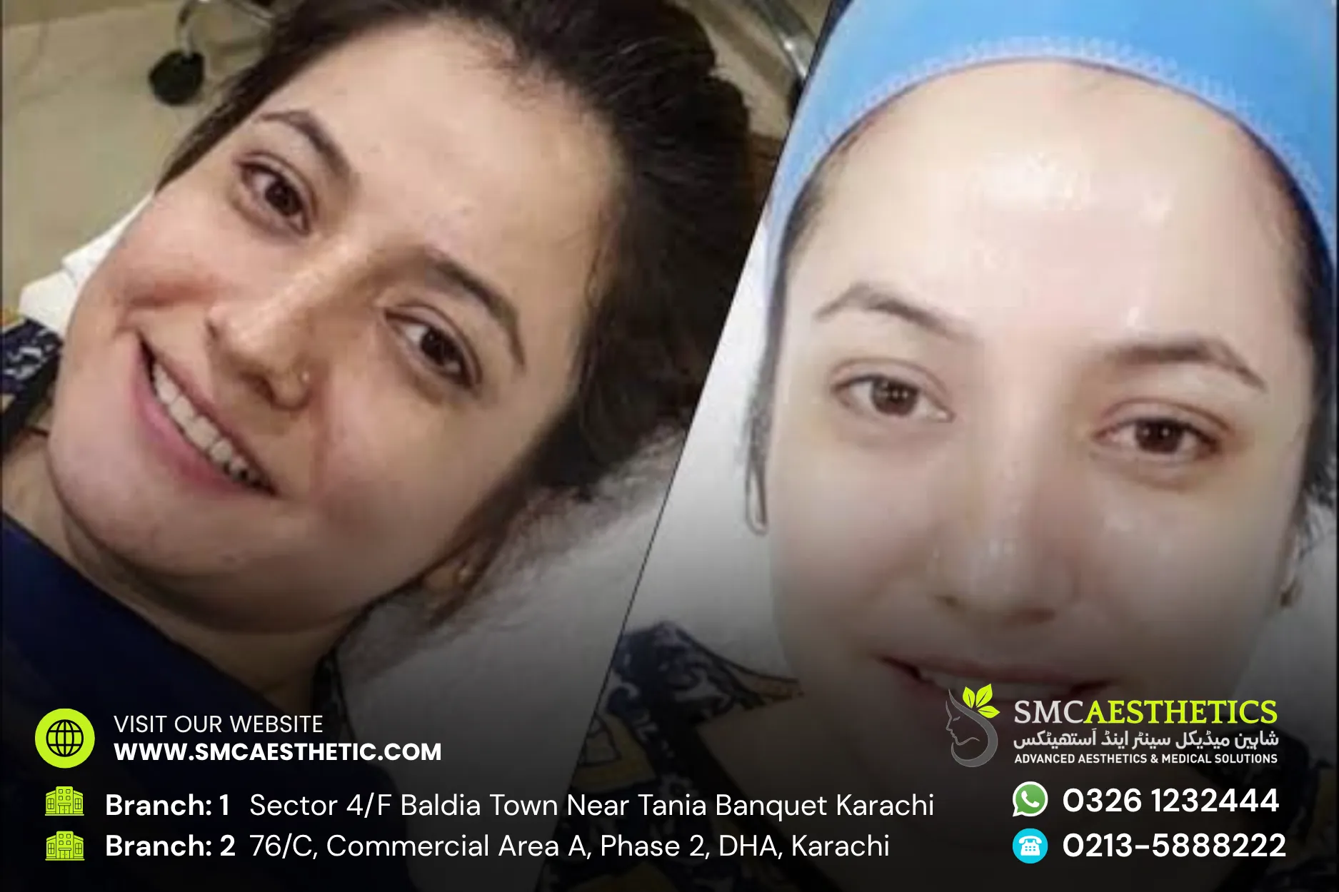 Skin Whitening Treatment Before and After Results - SMC Aesthetics Karachi