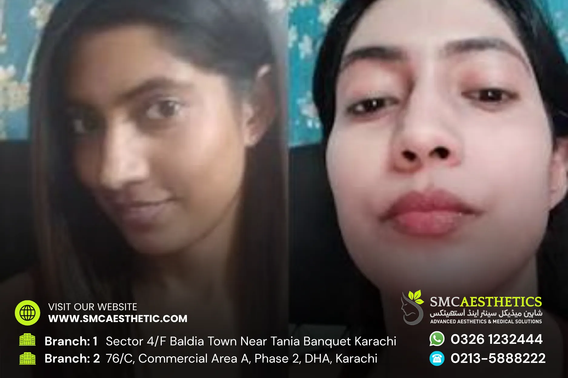 Skin Whitening Treatment Before and After Results - SMC Aesthetics Karachi