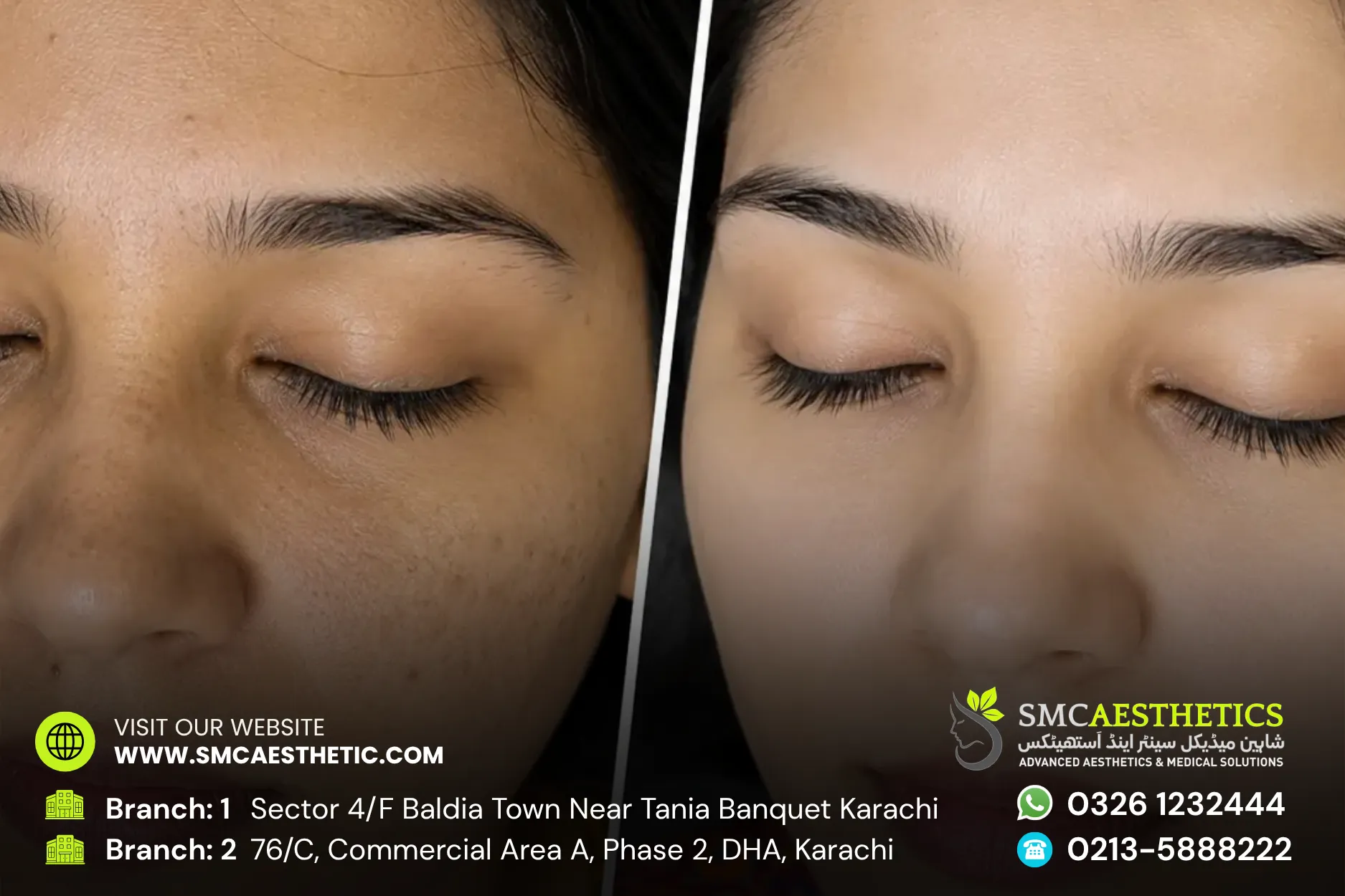 Skin Whitening Treatment Before and After Results - SMC Aesthetics Karachi