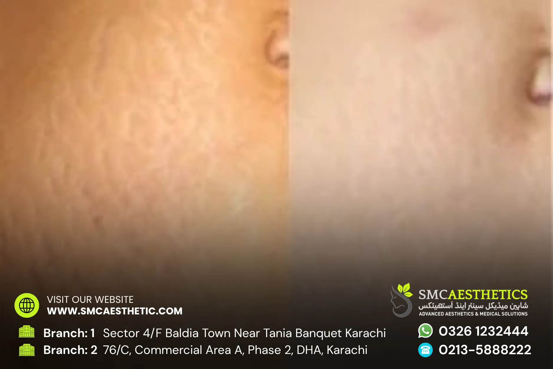 Before After Results